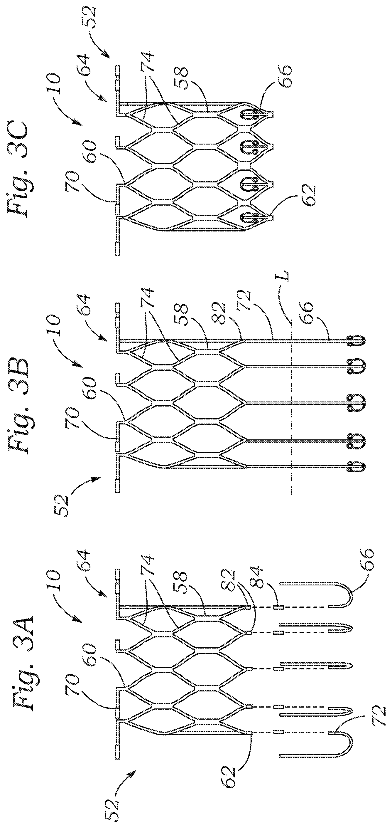 Patent US12403004 Figure 2 – Method for replacing a tricuspid valve