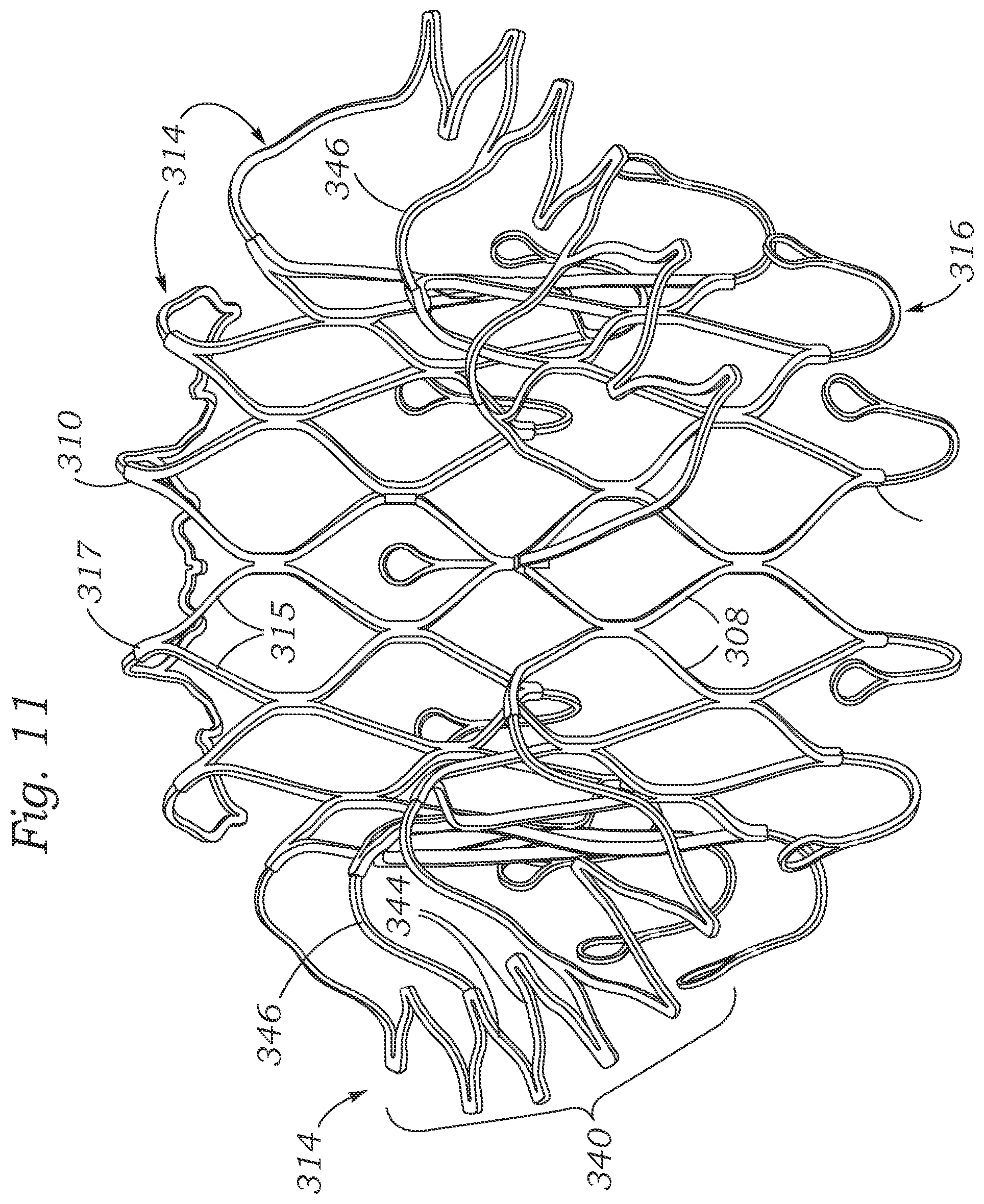 Patent US12403004 Figure 10 – Method for replacing a tricuspid valve