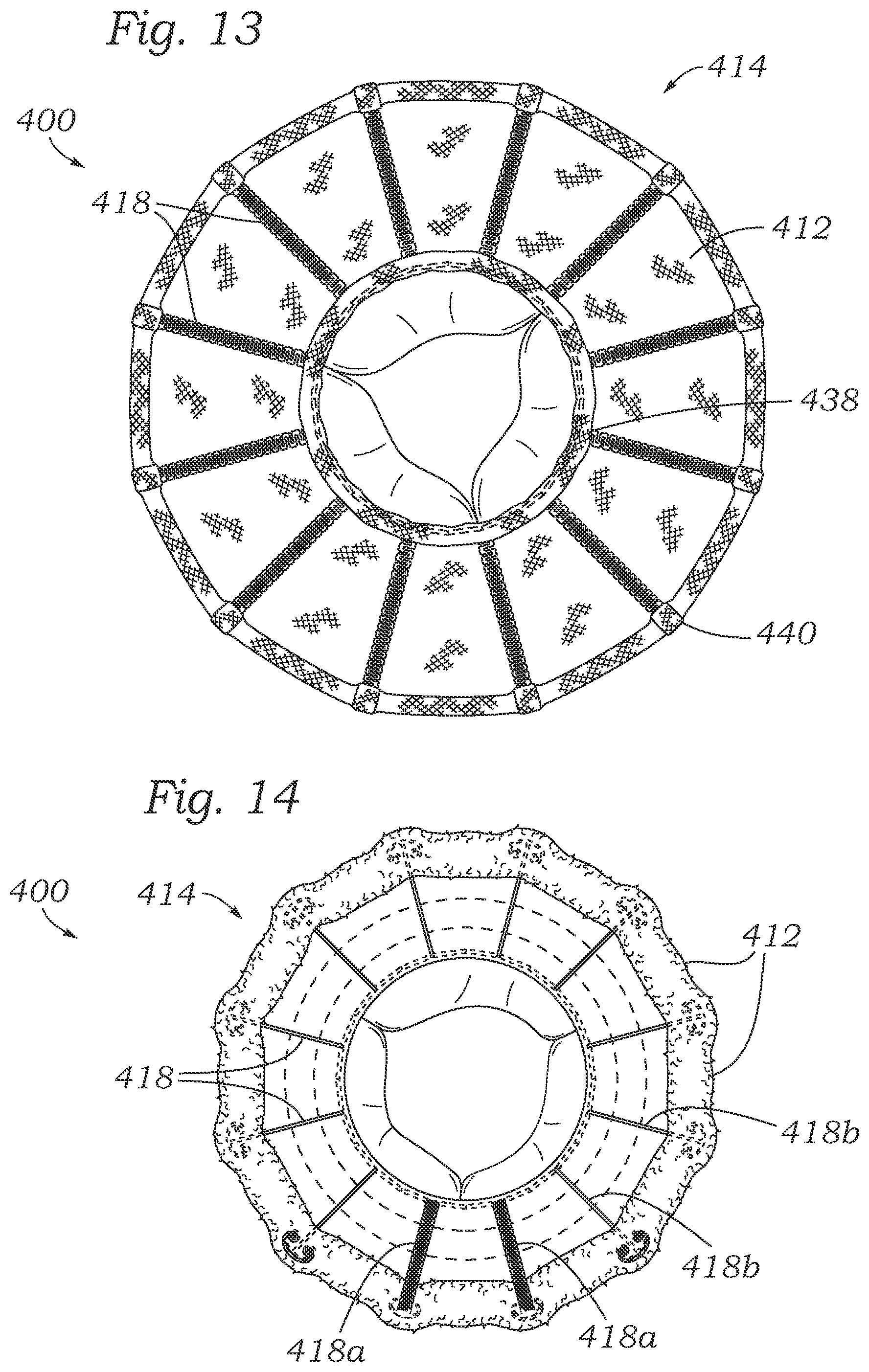 Patent US12403004 Figure 12 – Method for replacing a tricuspid valve