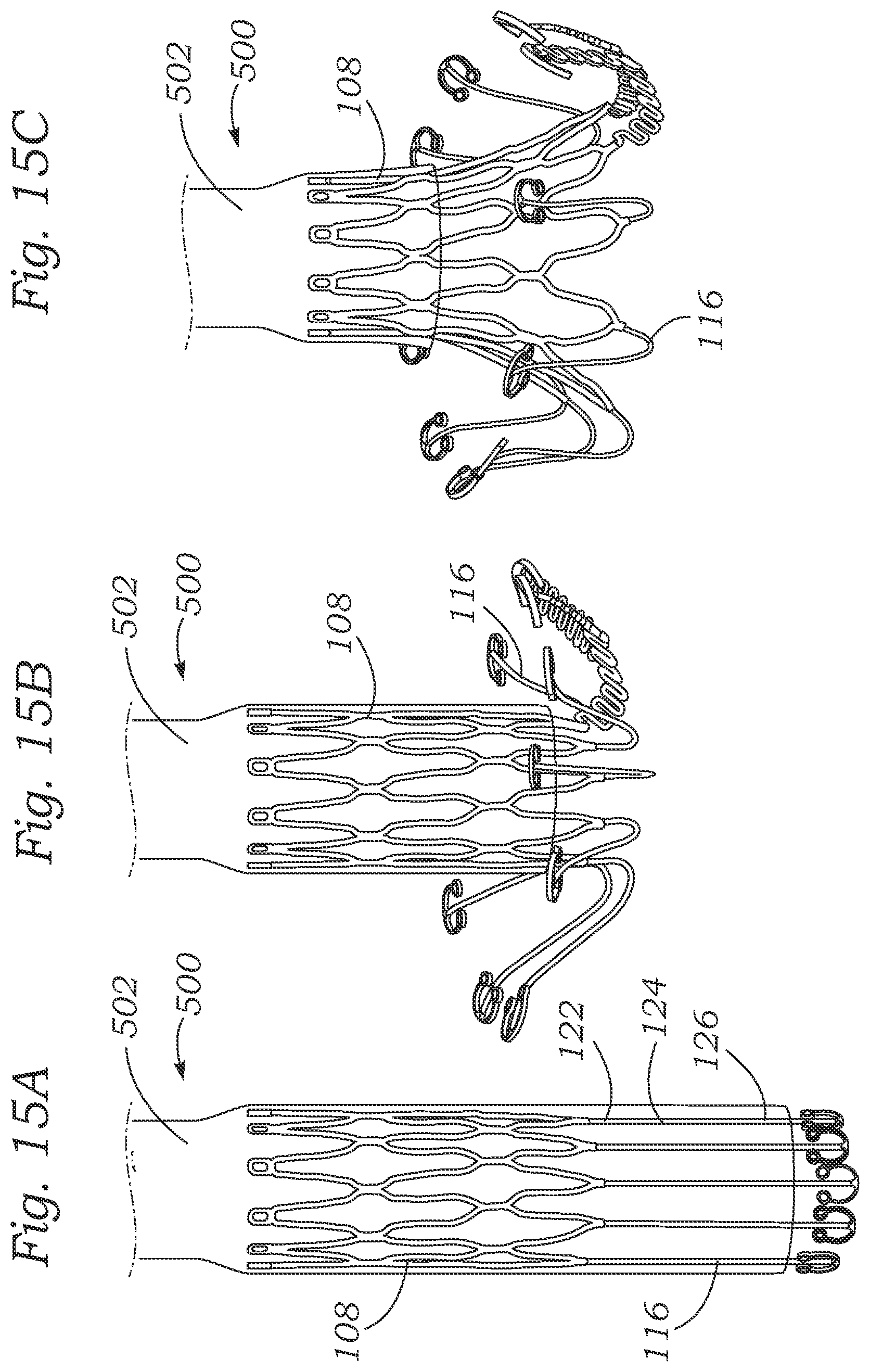 Patent US12403004 Figure 13 – Method for replacing a tricuspid valve