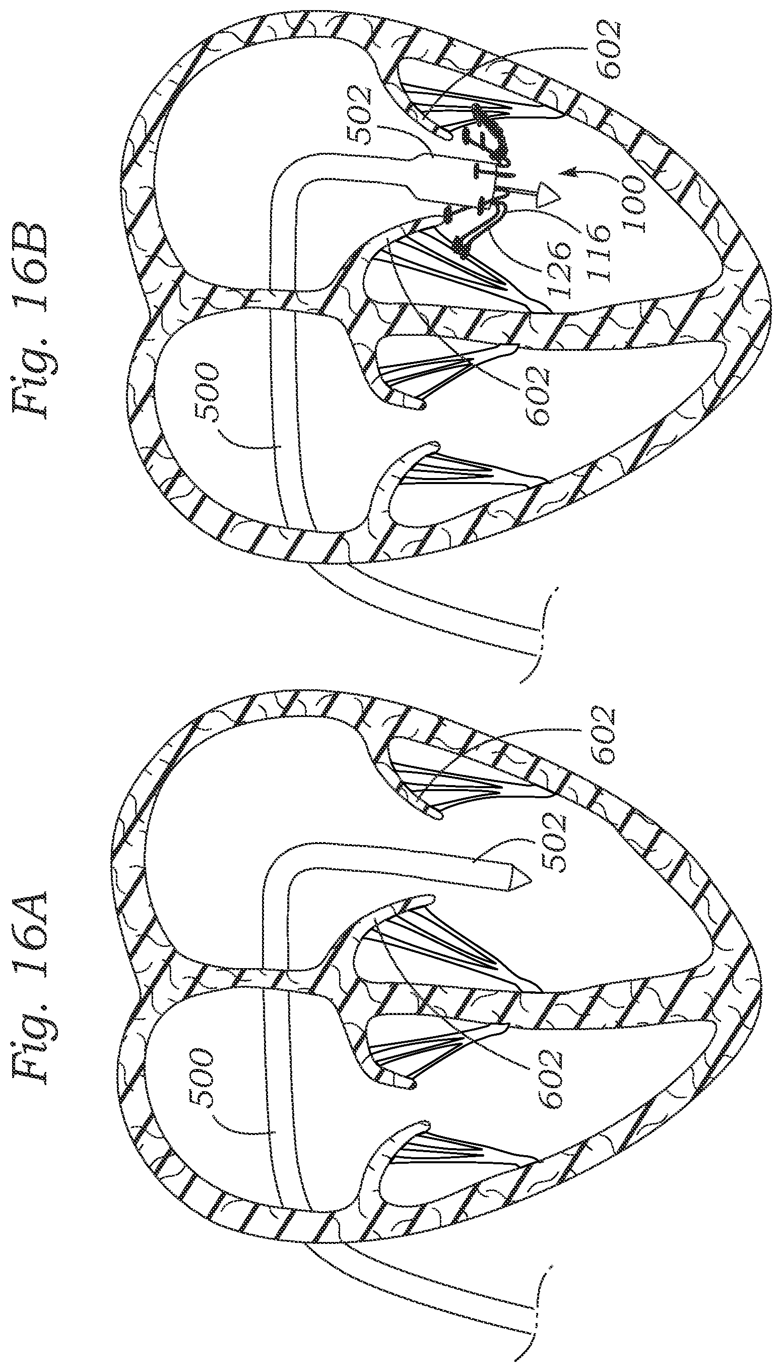 Patent US12403004 Figure 14 – Method for replacing a tricuspid valve