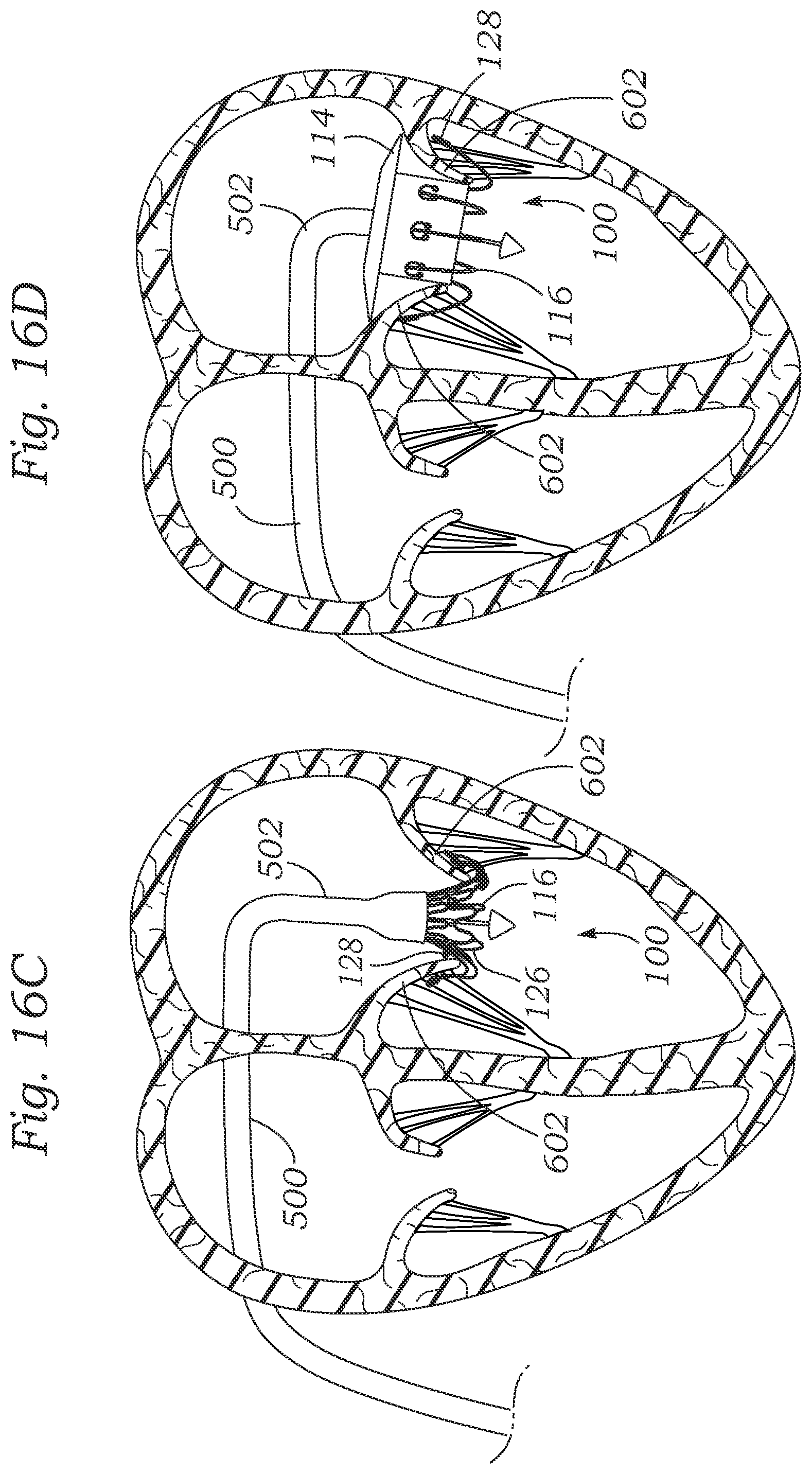 Patent US12403004 Figure 15 – Method for replacing a tricuspid valve