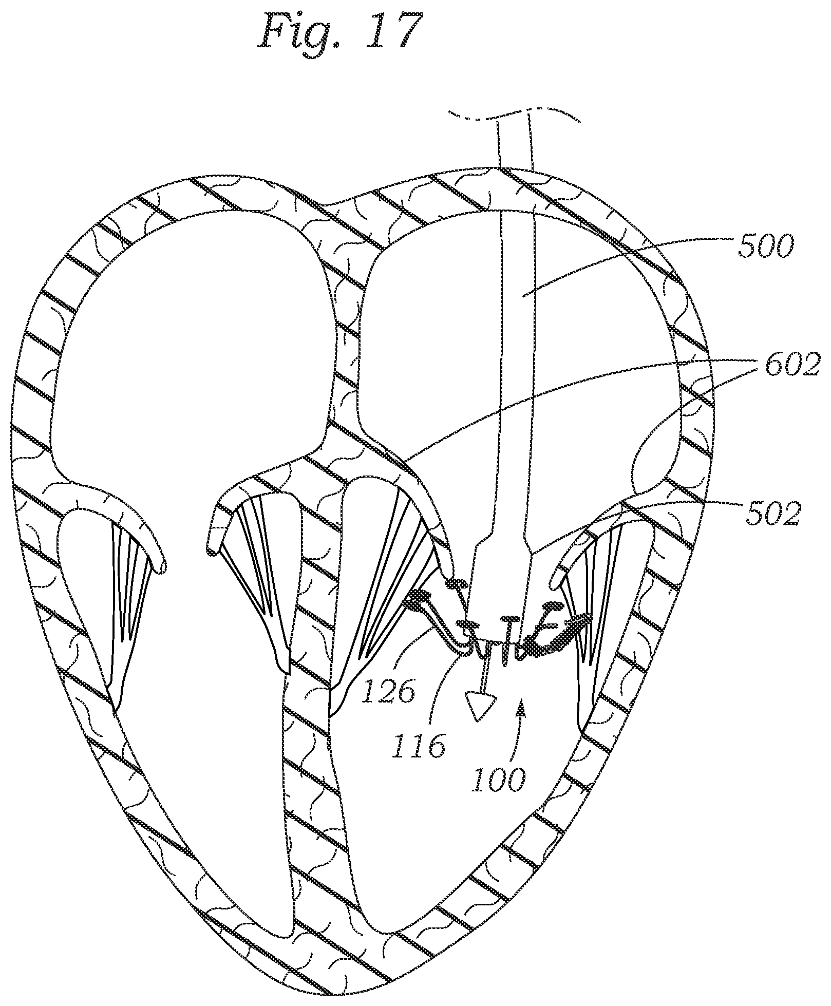Patent US12403004 Figure 16 – Method for replacing a tricuspid valve