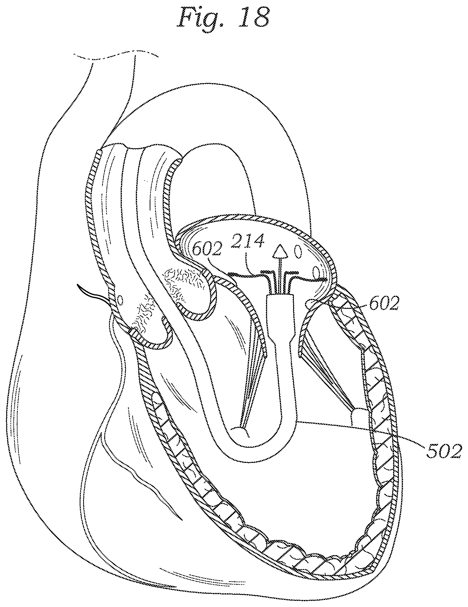 Patent US12403004 Figure 17 – Method for replacing a tricuspid valve