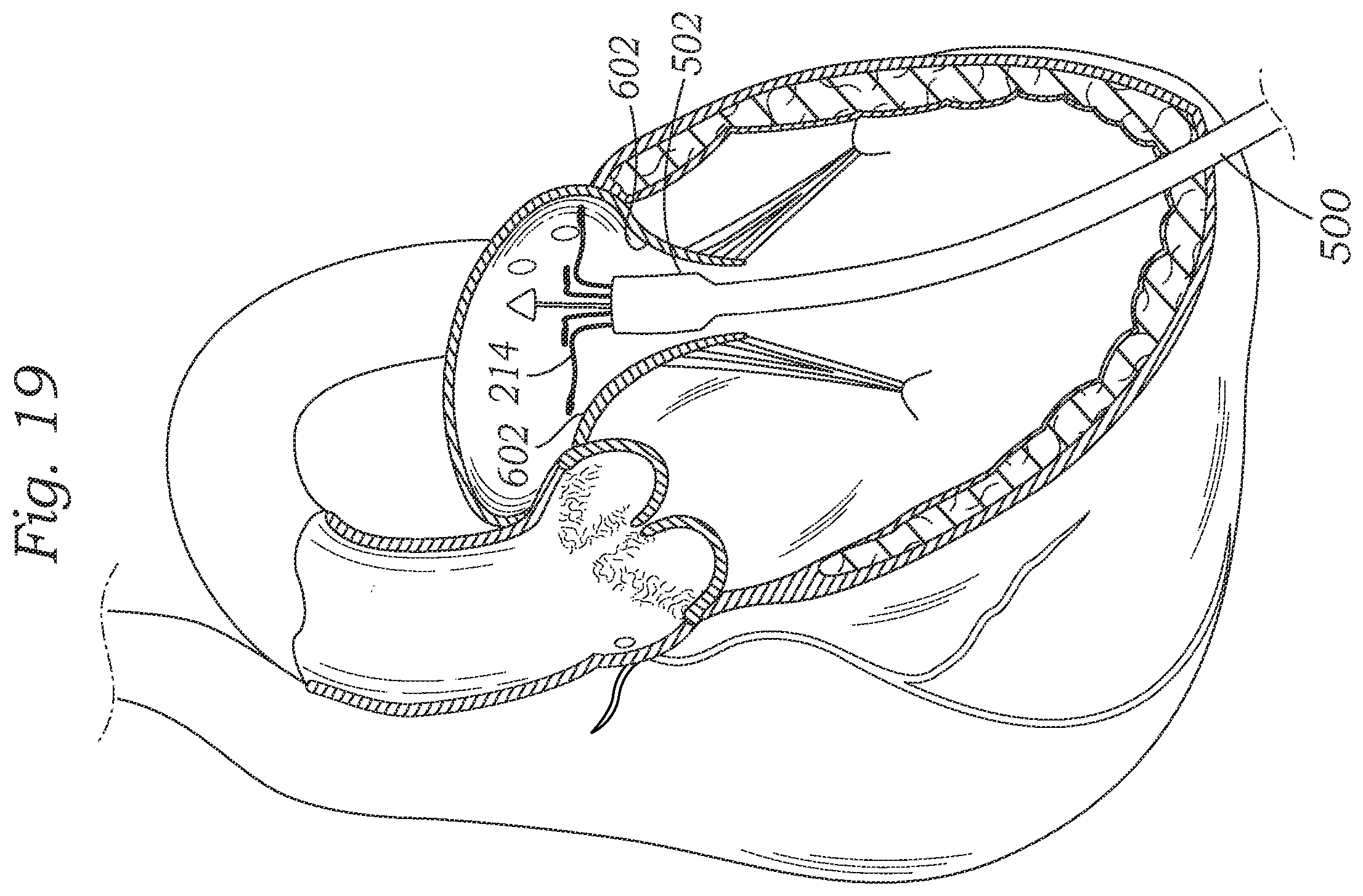 Patent US12403004 Figure 18 – Method for replacing a tricuspid valve