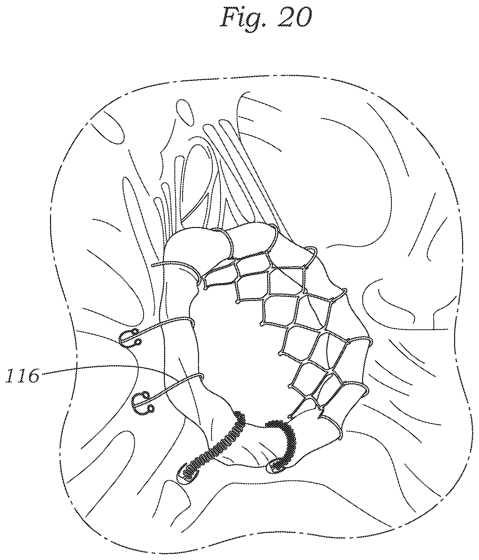 Patent US12403004 Figure 19 – Method for replacing a tricuspid valve