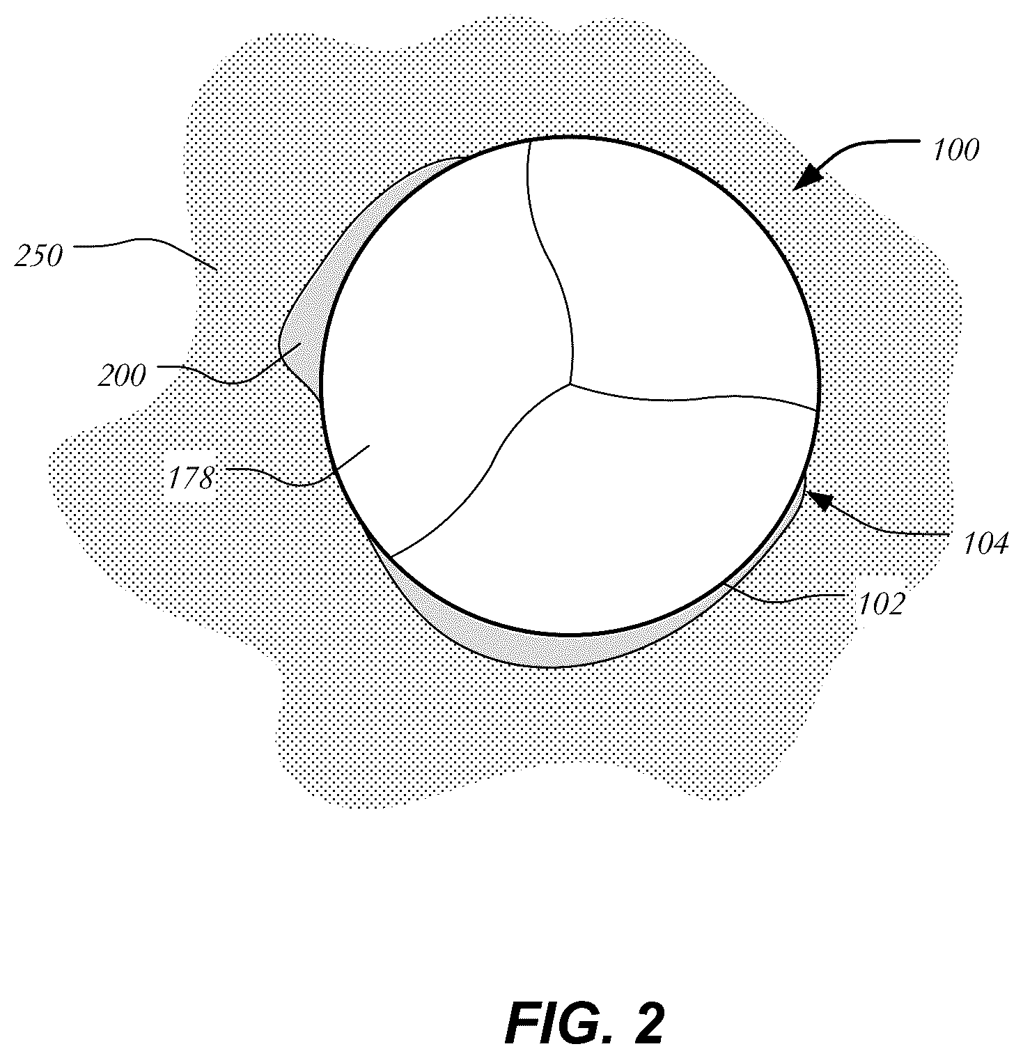 Patent US12403005 Figure 2 – Bowed runners and corresponding valve assemblies for paravalvular leak protection