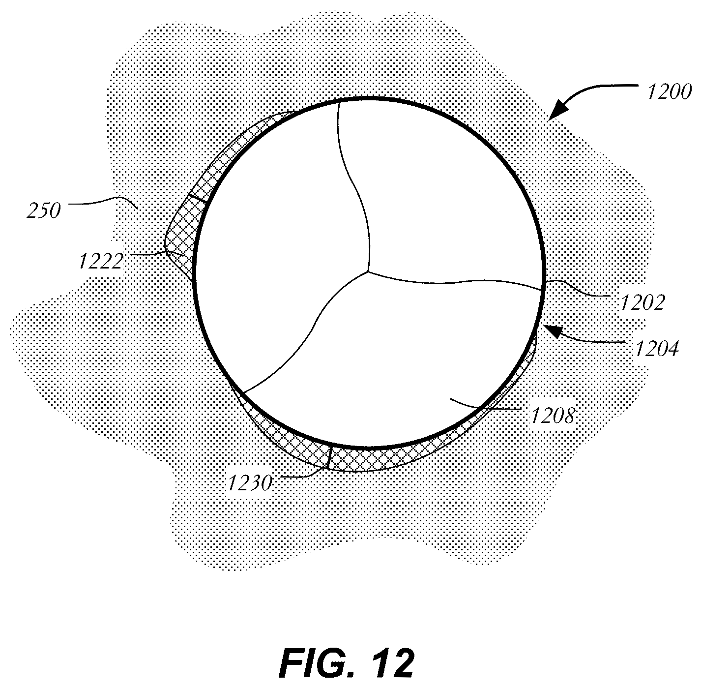 Patent US12403005 Figure 10 – Bowed runners and corresponding valve assemblies for paravalvular leak protection