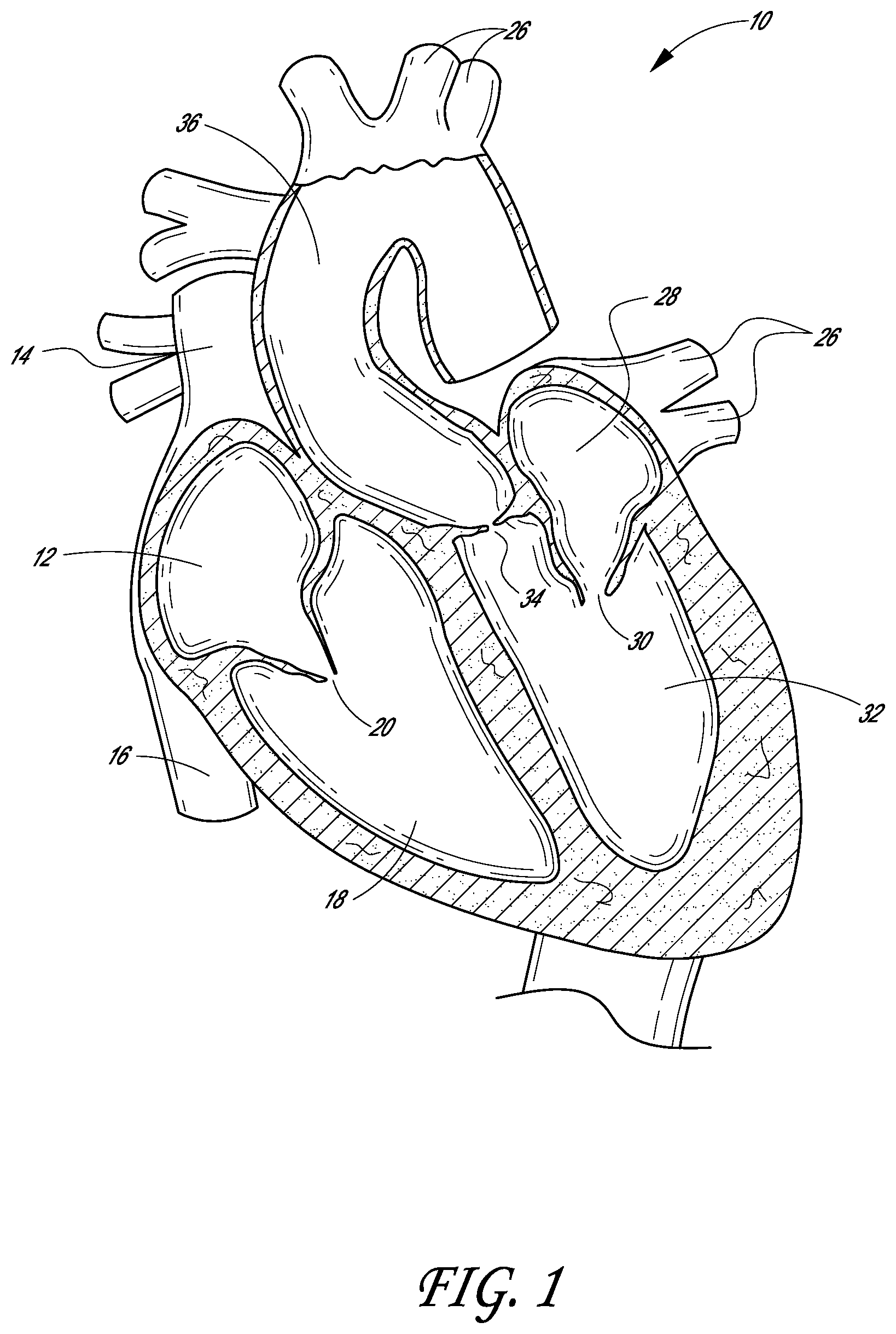 Patent US12403007 Figure 1 – Prosthetic implant delivery device with introducer catheter