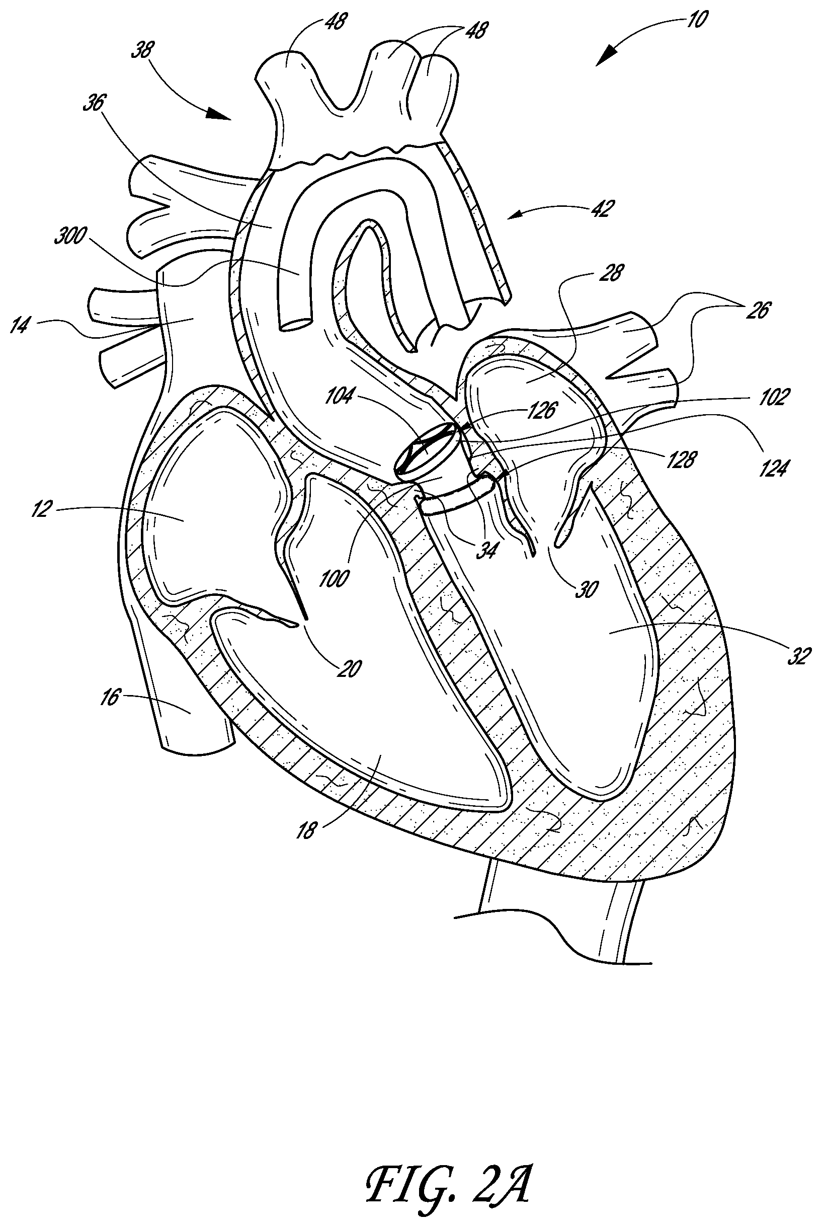 Patent US12403007 Figure 2 – Prosthetic implant delivery device with introducer catheter