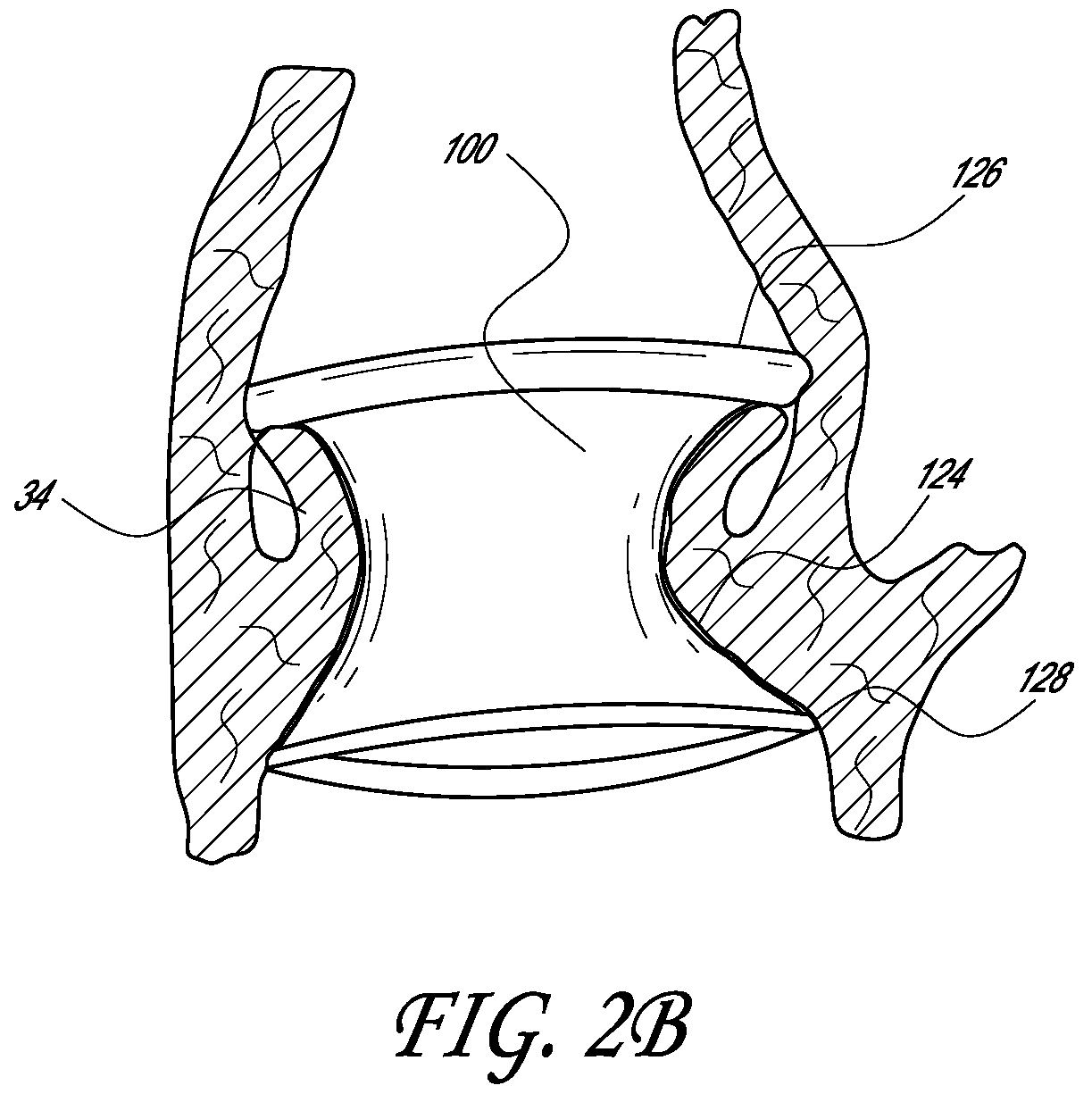 Patent US12403007 Figure 3 – Prosthetic implant delivery device with introducer catheter
