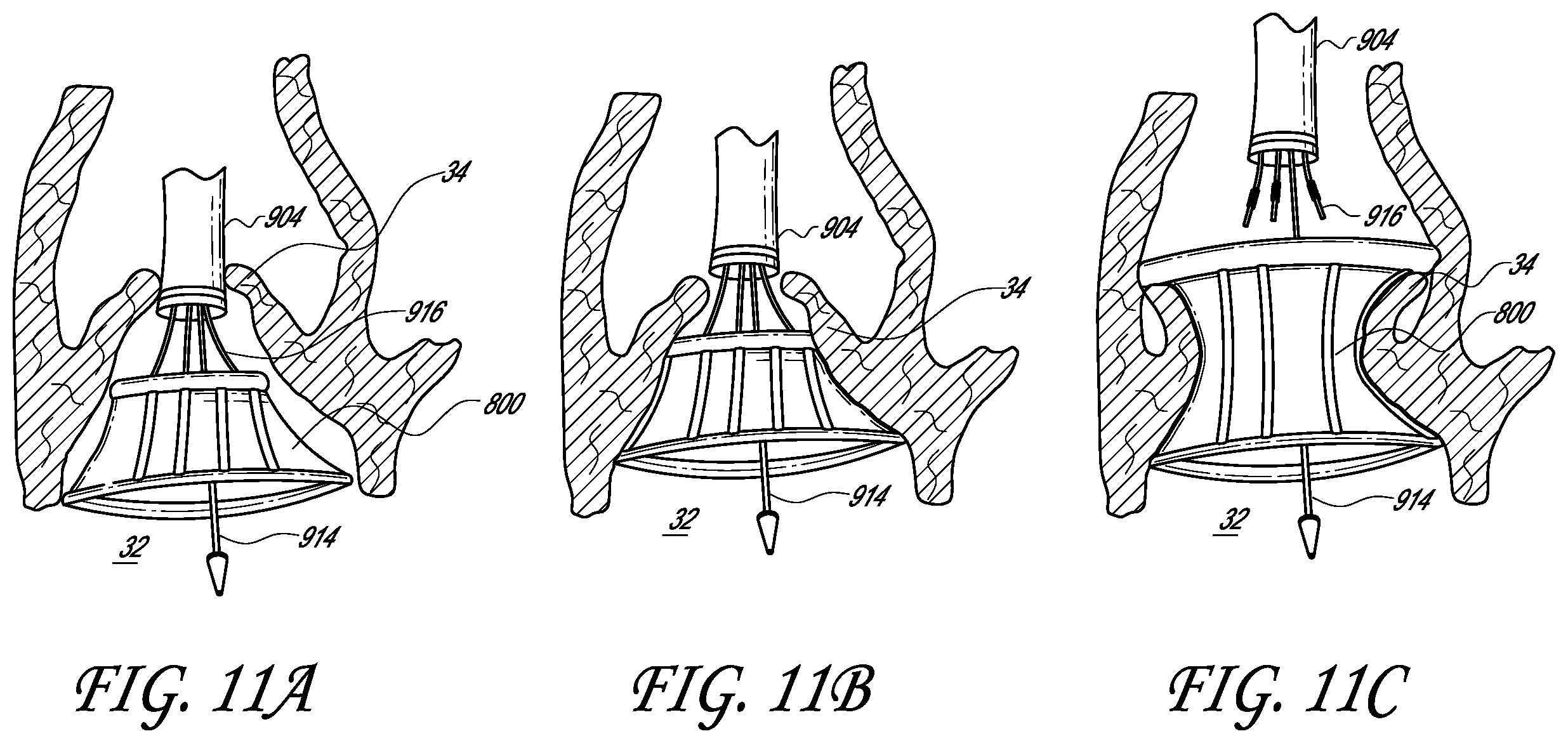 Patent US12403007 Figure 15 – Prosthetic implant delivery device with introducer catheter