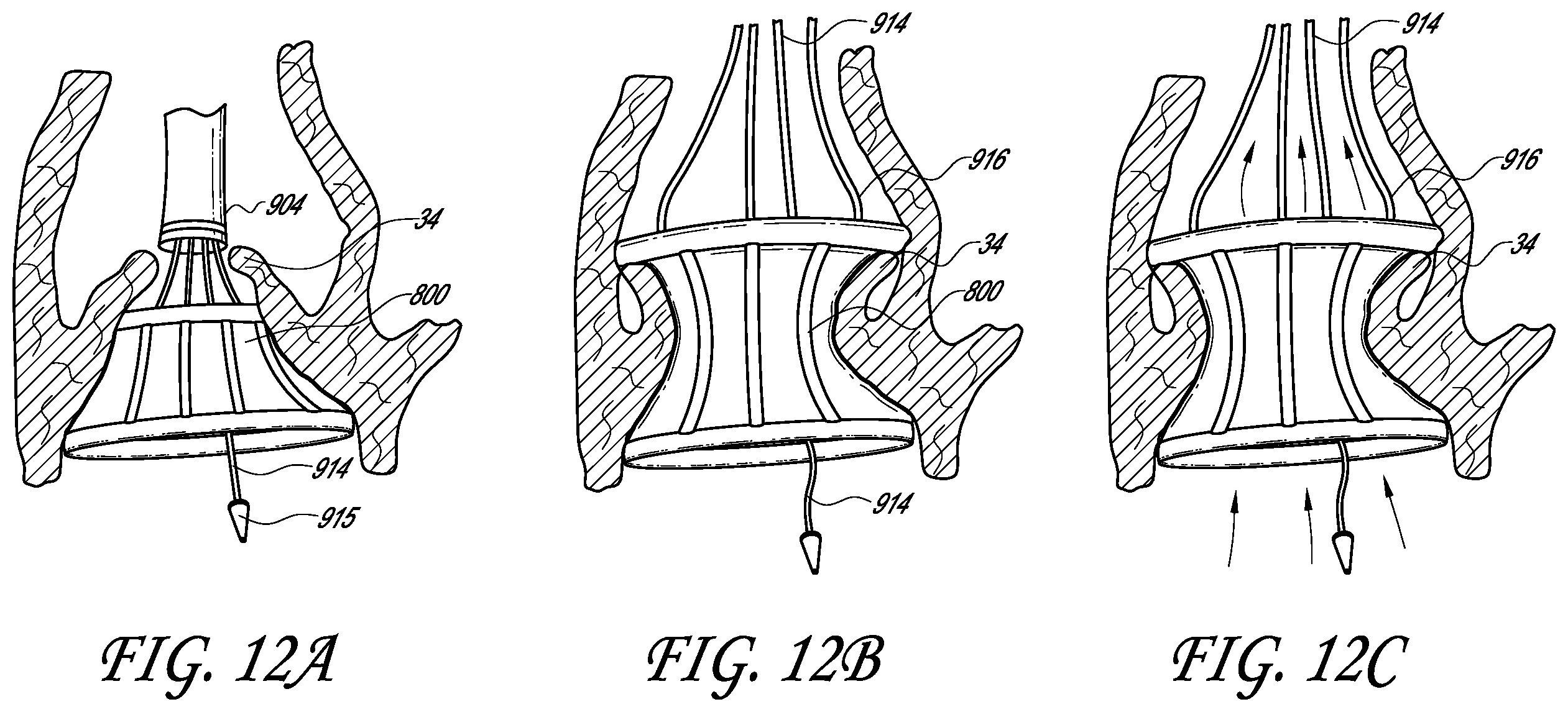 Patent US12403007 Figure 16 – Prosthetic implant delivery device with introducer catheter