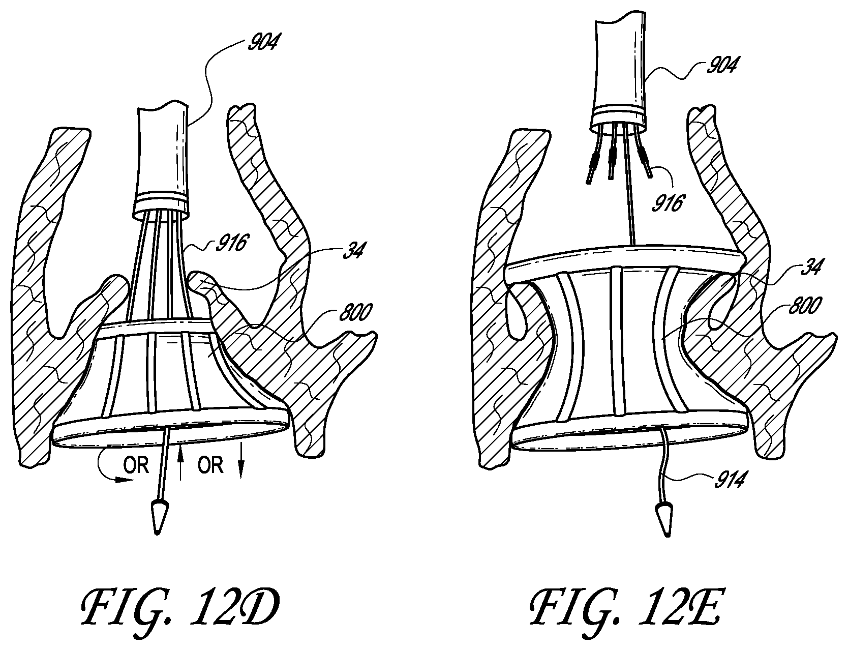 Patent US12403007 Figure 17 – Prosthetic implant delivery device with introducer catheter