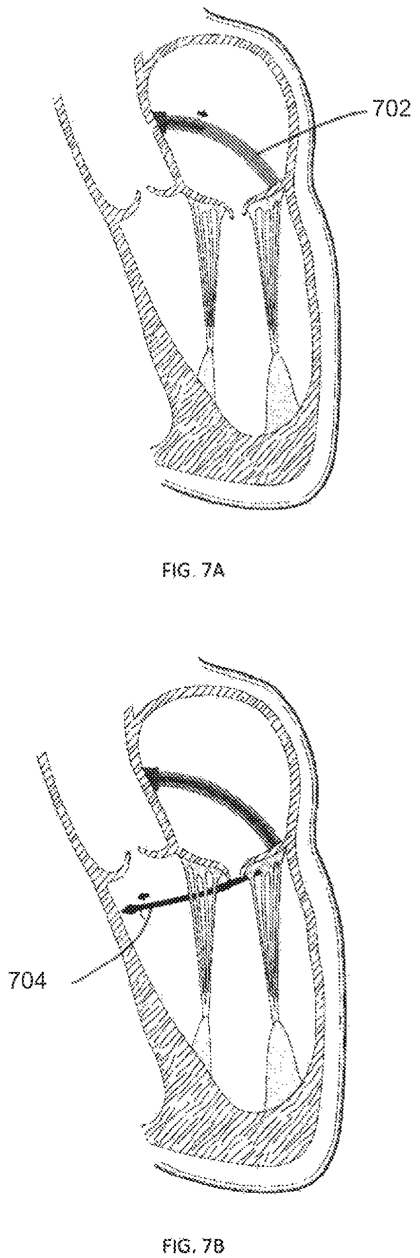Patent US12403008 Figure 7 – Adjustable medical device
