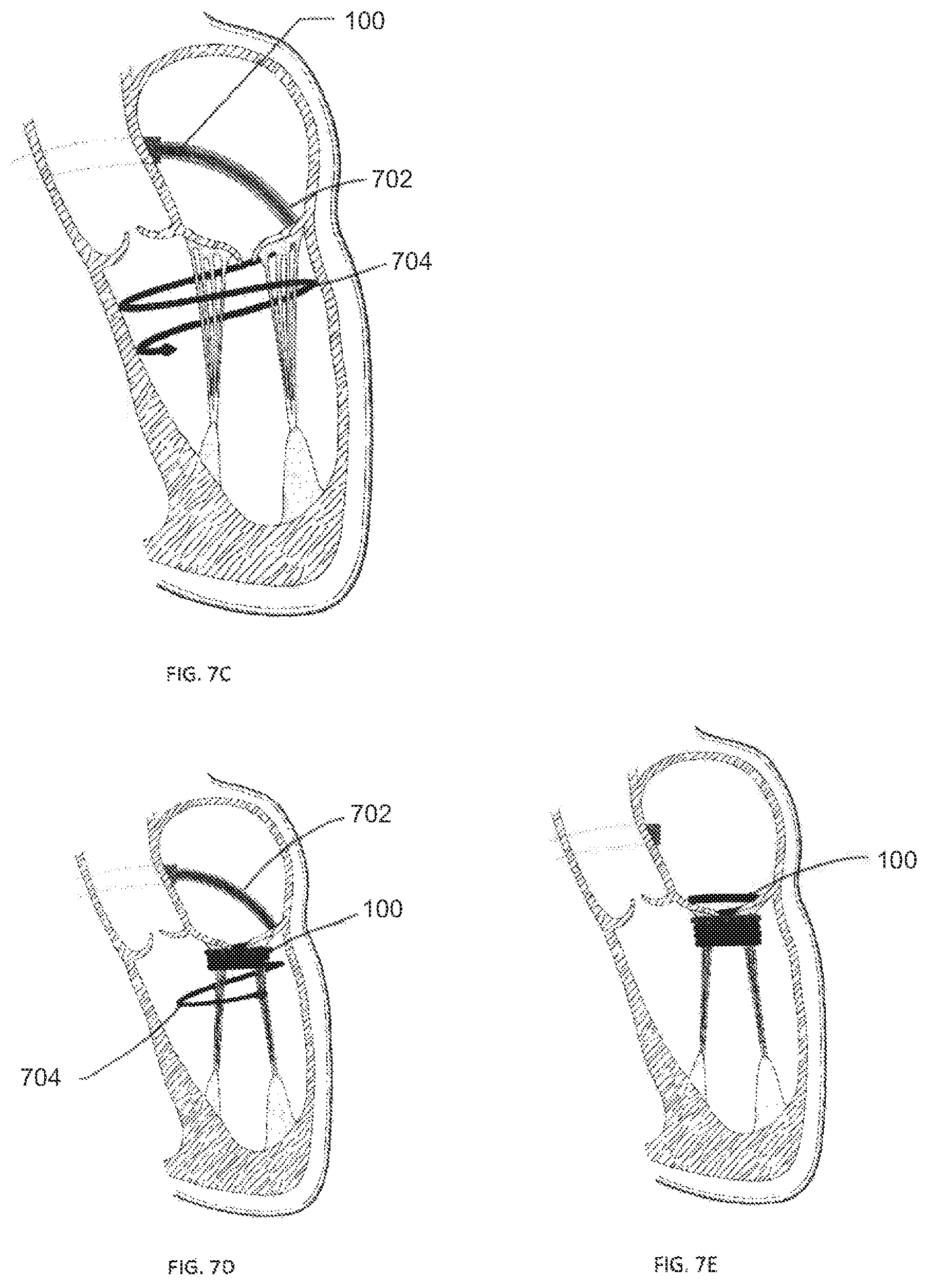 Patent US12403008 Figure 8 – Adjustable medical device