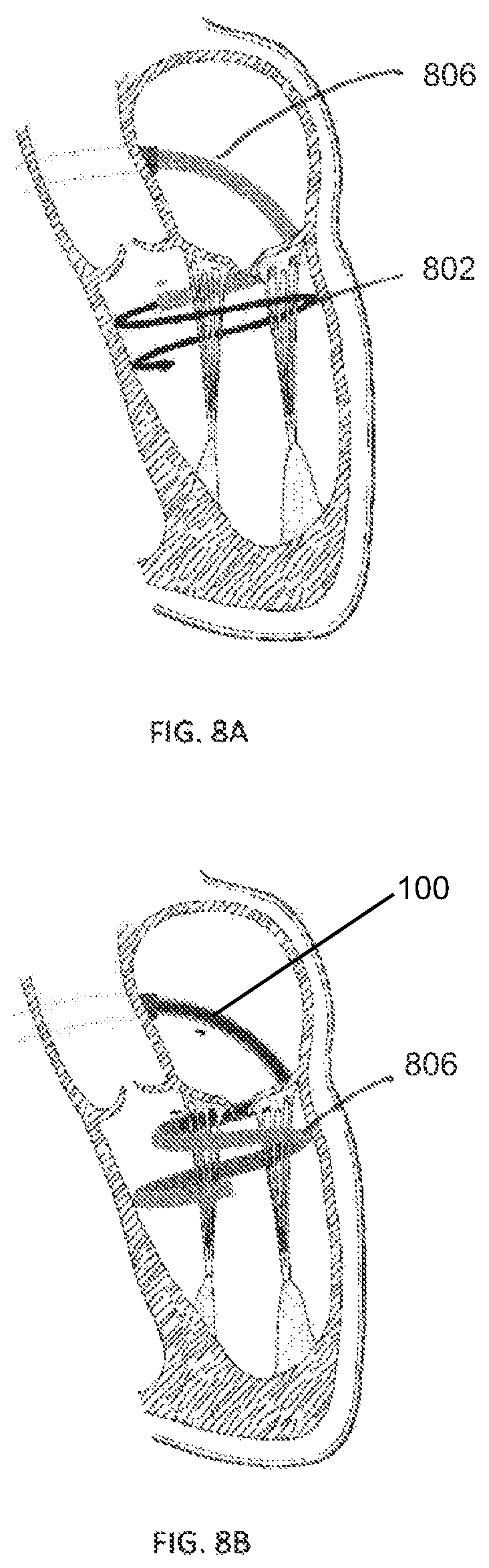 Patent US12403008 Figure 9 – Adjustable medical device