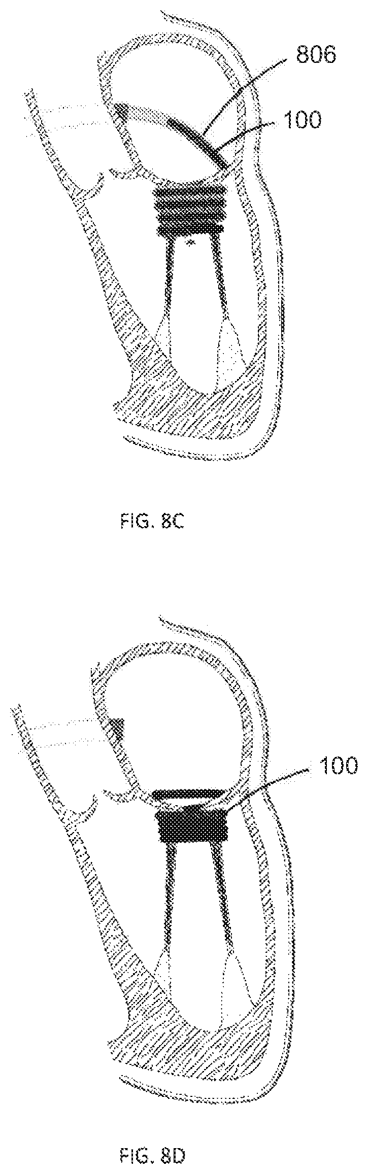 Patent US12403008 Figure 10 – Adjustable medical device