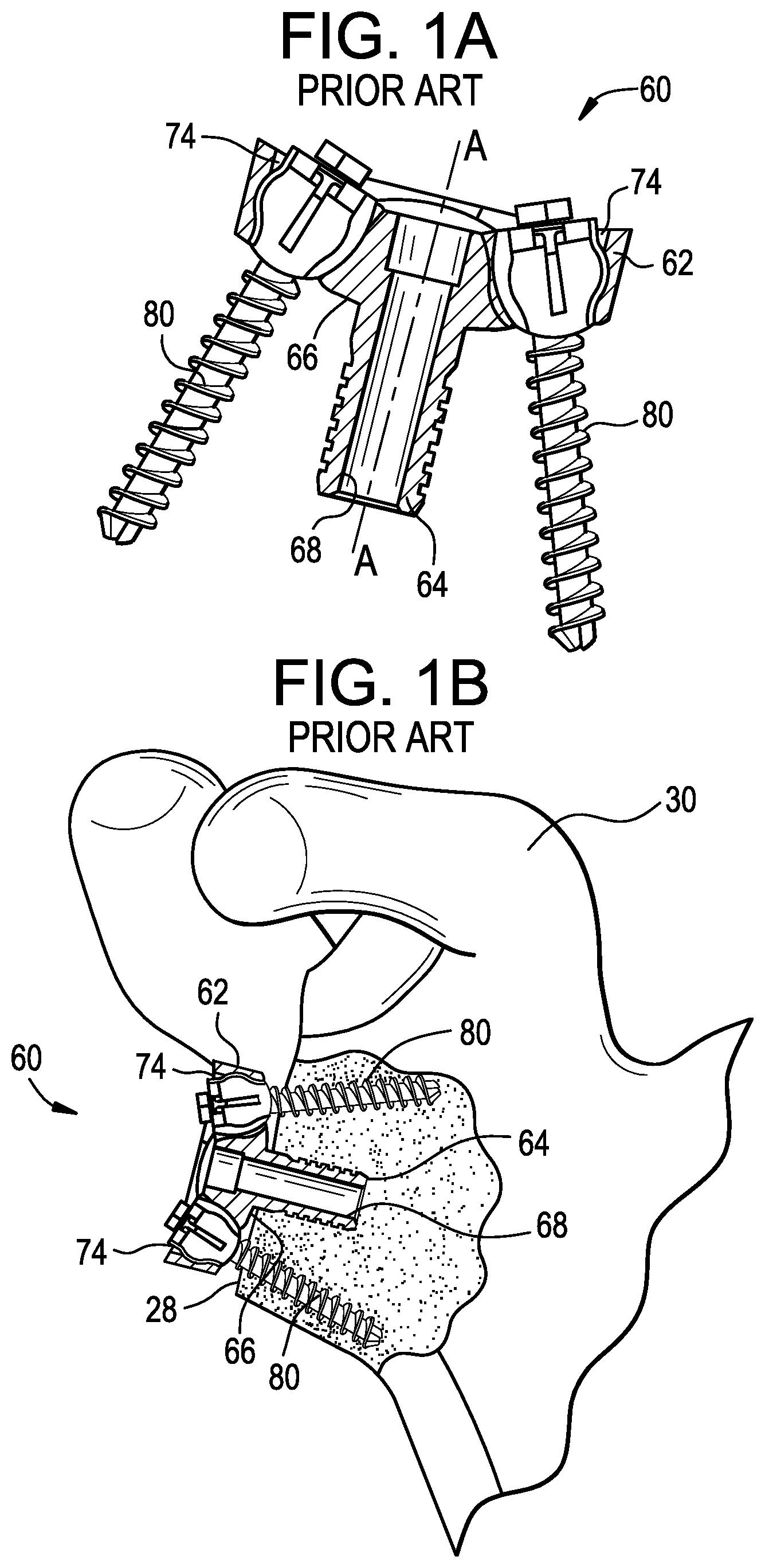 Patent US12403011 — Baseplate of a modular shoulder joint prosthesis and related methods for implanting the same — Figure 1