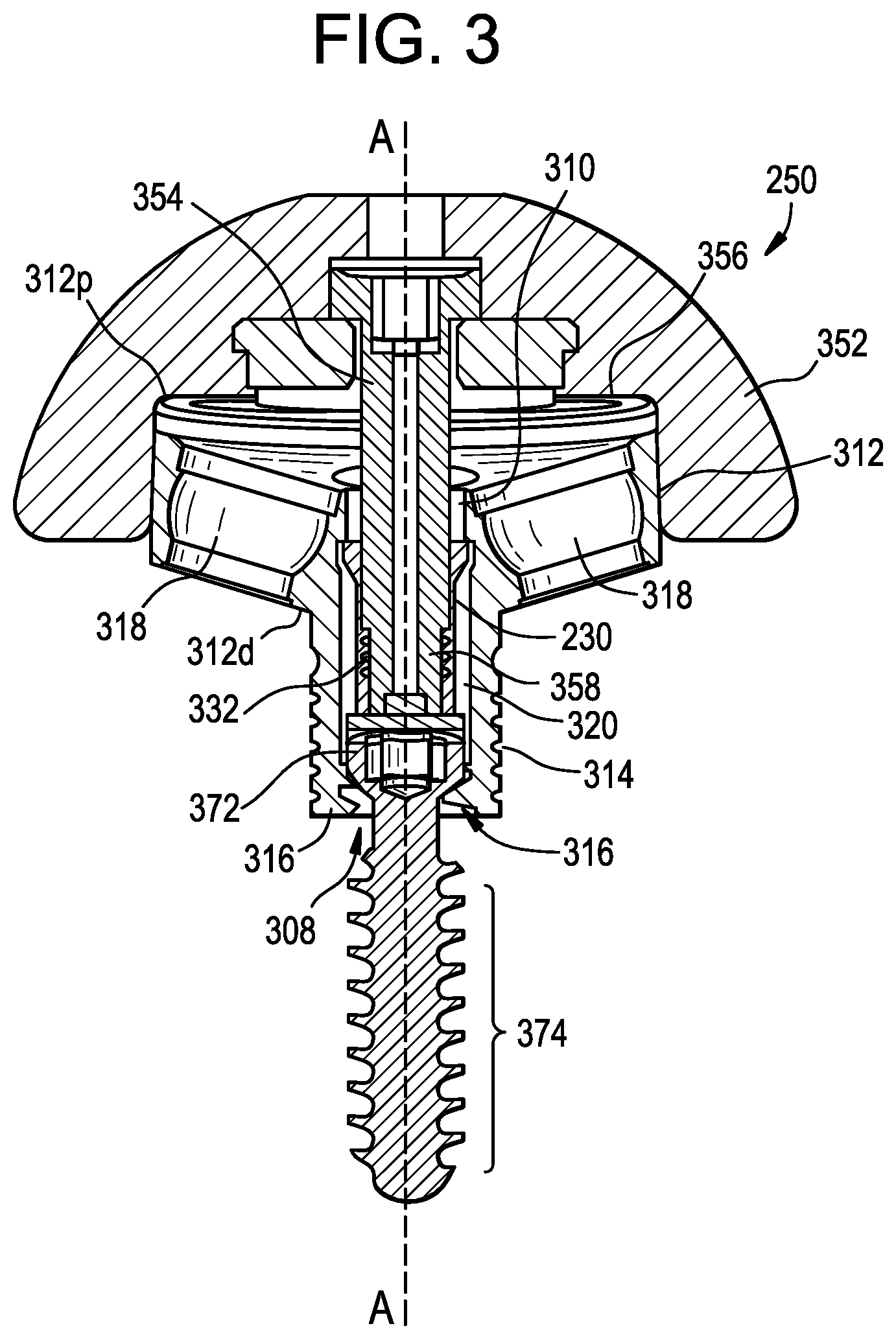 Patent US12403011 Figure 3 – Baseplate of a modular shoulder joint prosthesis and related methods for implanting the same