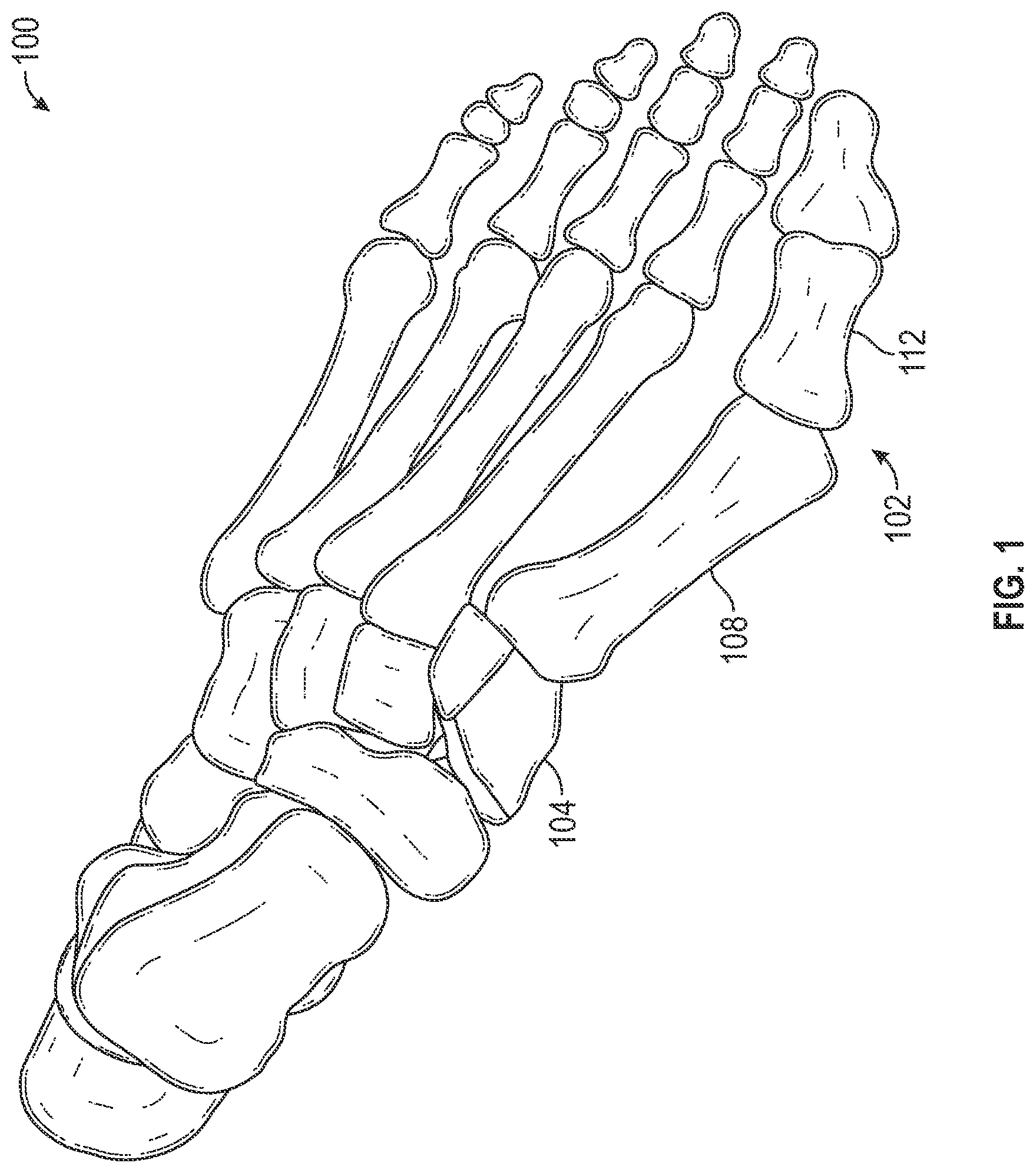 Patent US12403012 Figure 1 – Bone repositioning guide system and procedure