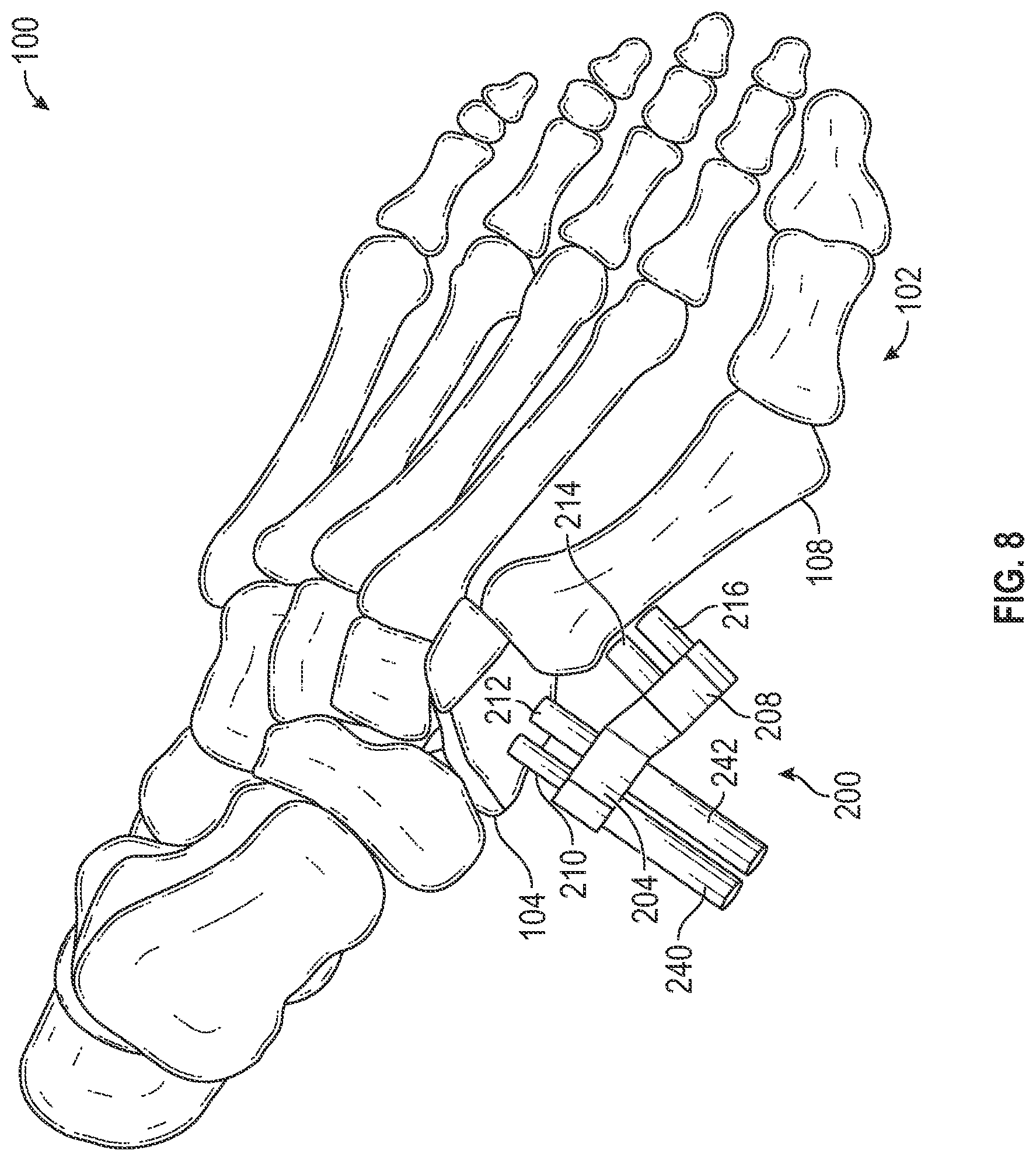 Patent US12403012 Figure 8 – Bone repositioning guide system and procedure