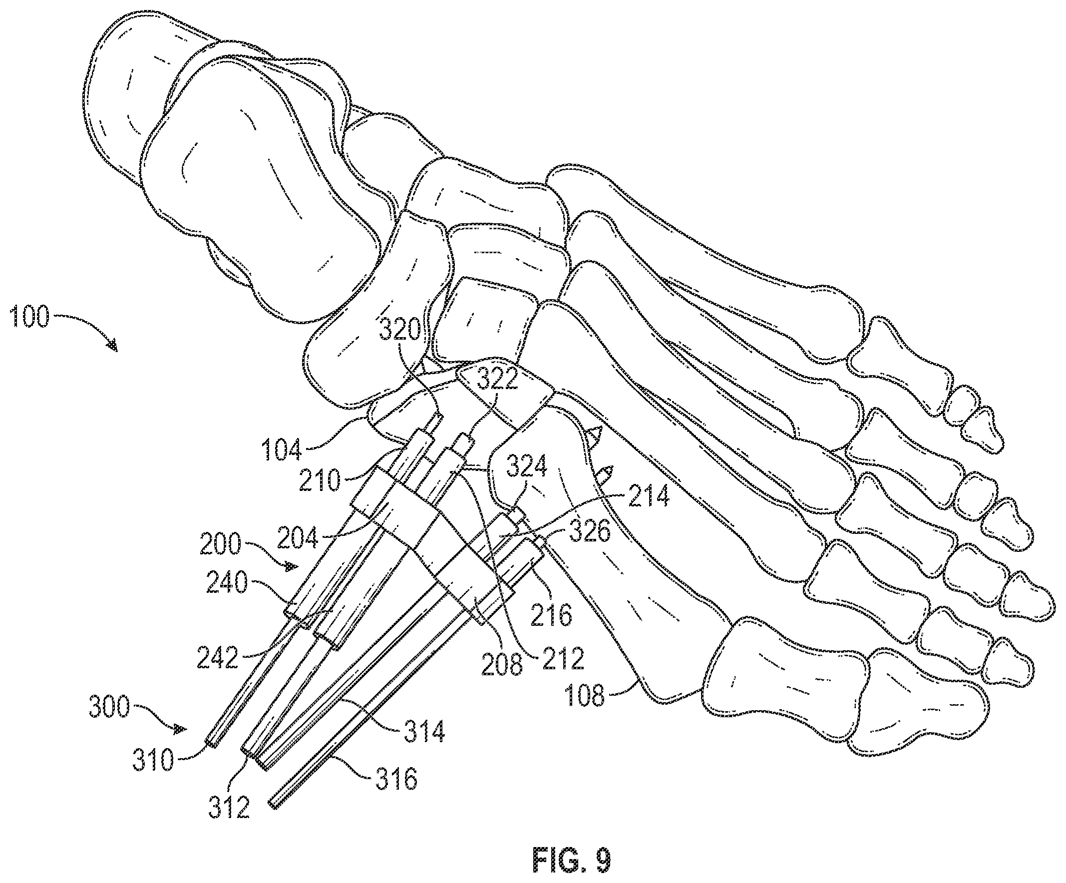 Patent US12403012 Figure 9 – Bone repositioning guide system and procedure