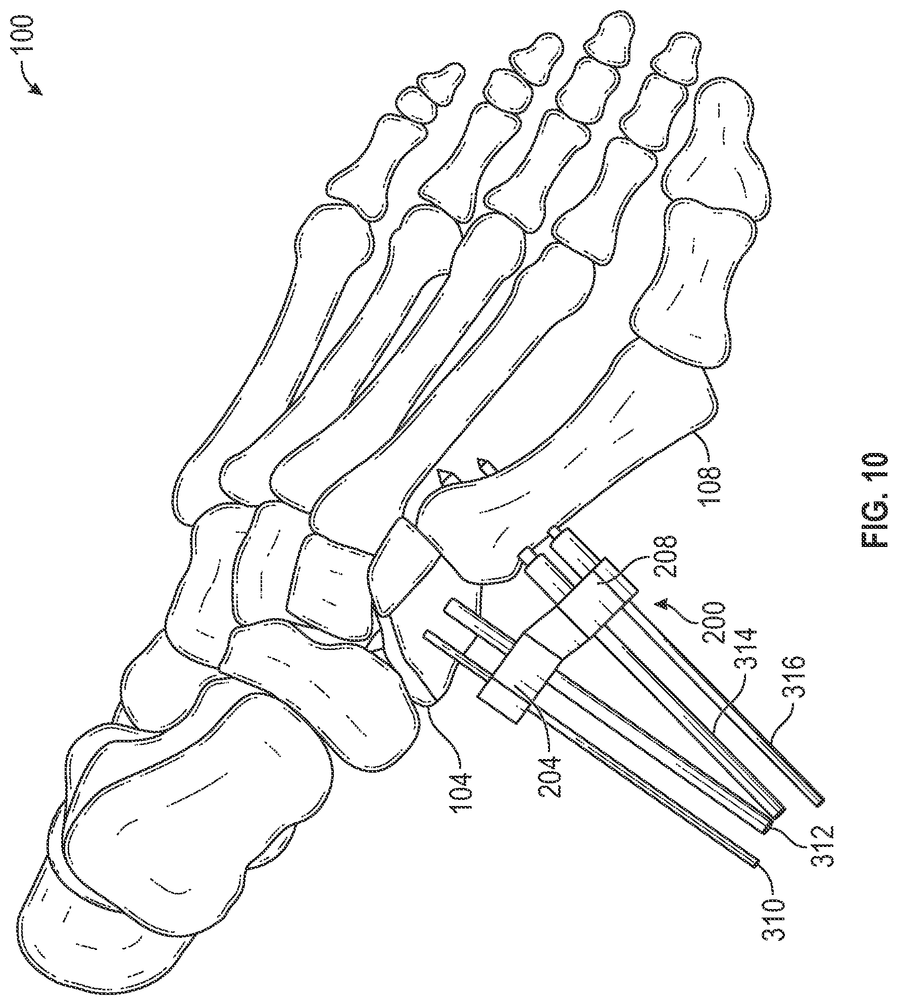 Patent US12403012 Figure 10 – Bone repositioning guide system and procedure