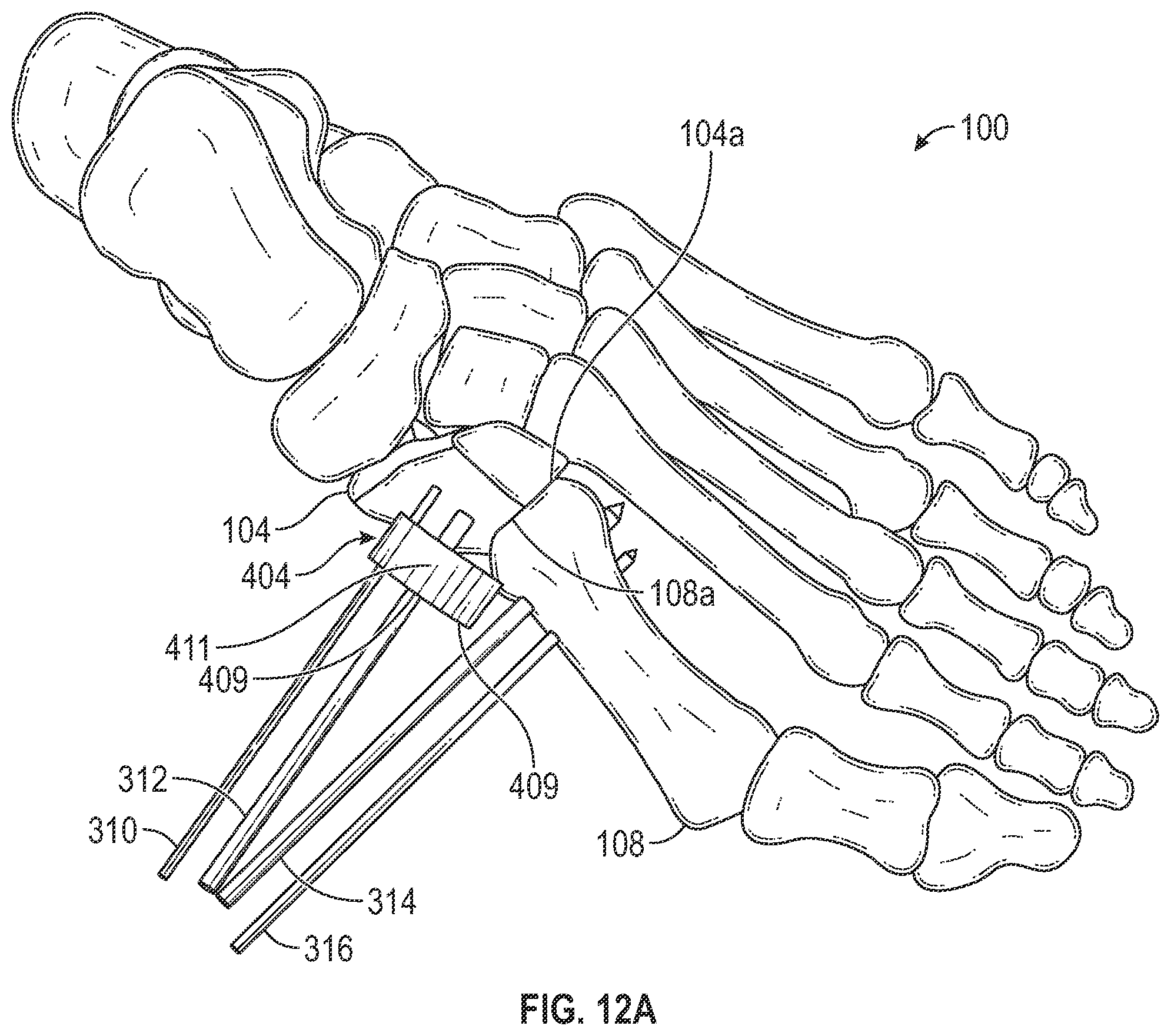 Patent US12403012 Figure 12 – Bone repositioning guide system and procedure