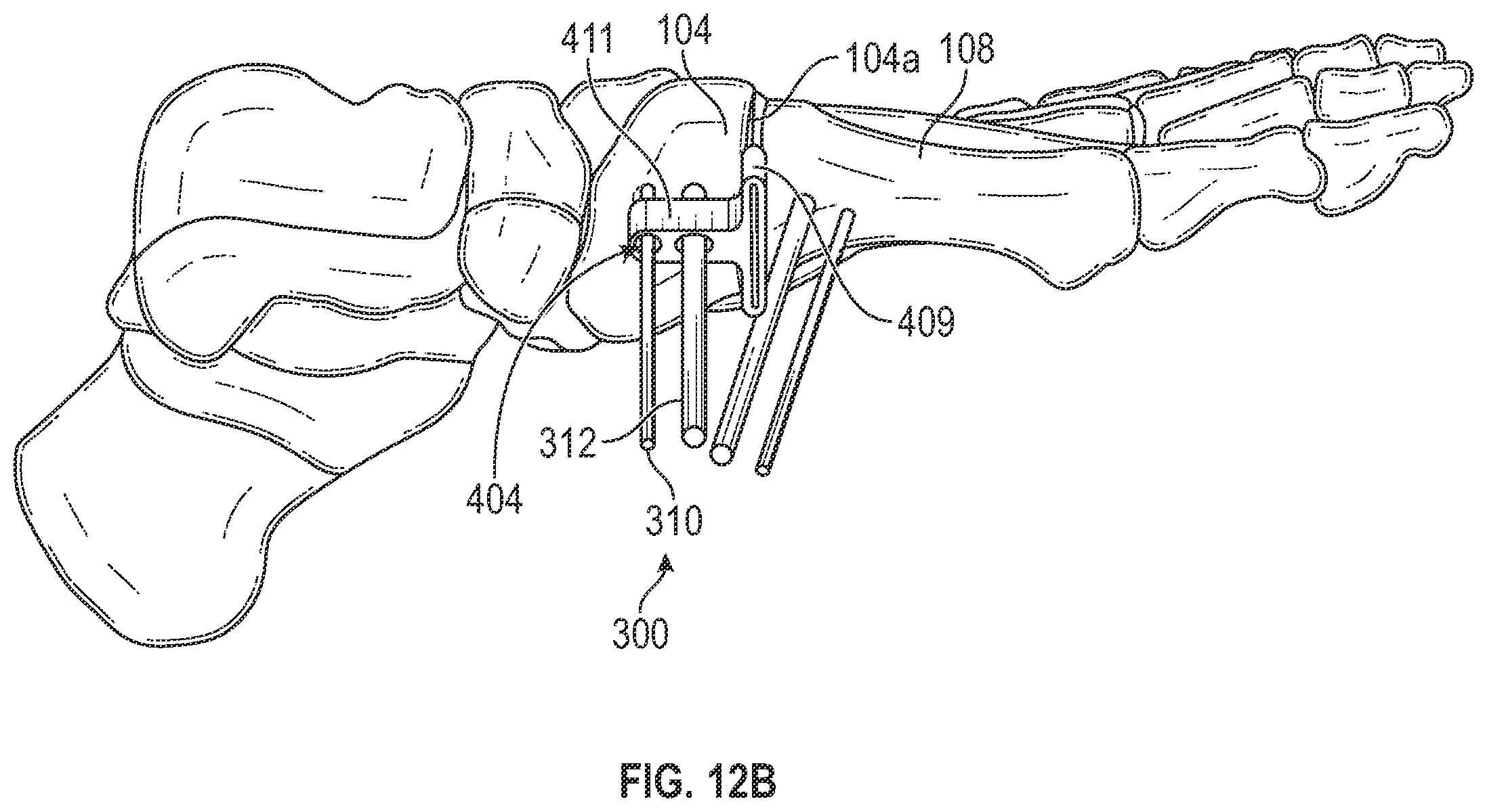 Patent US12403012 Figure 13 – Bone repositioning guide system and procedure