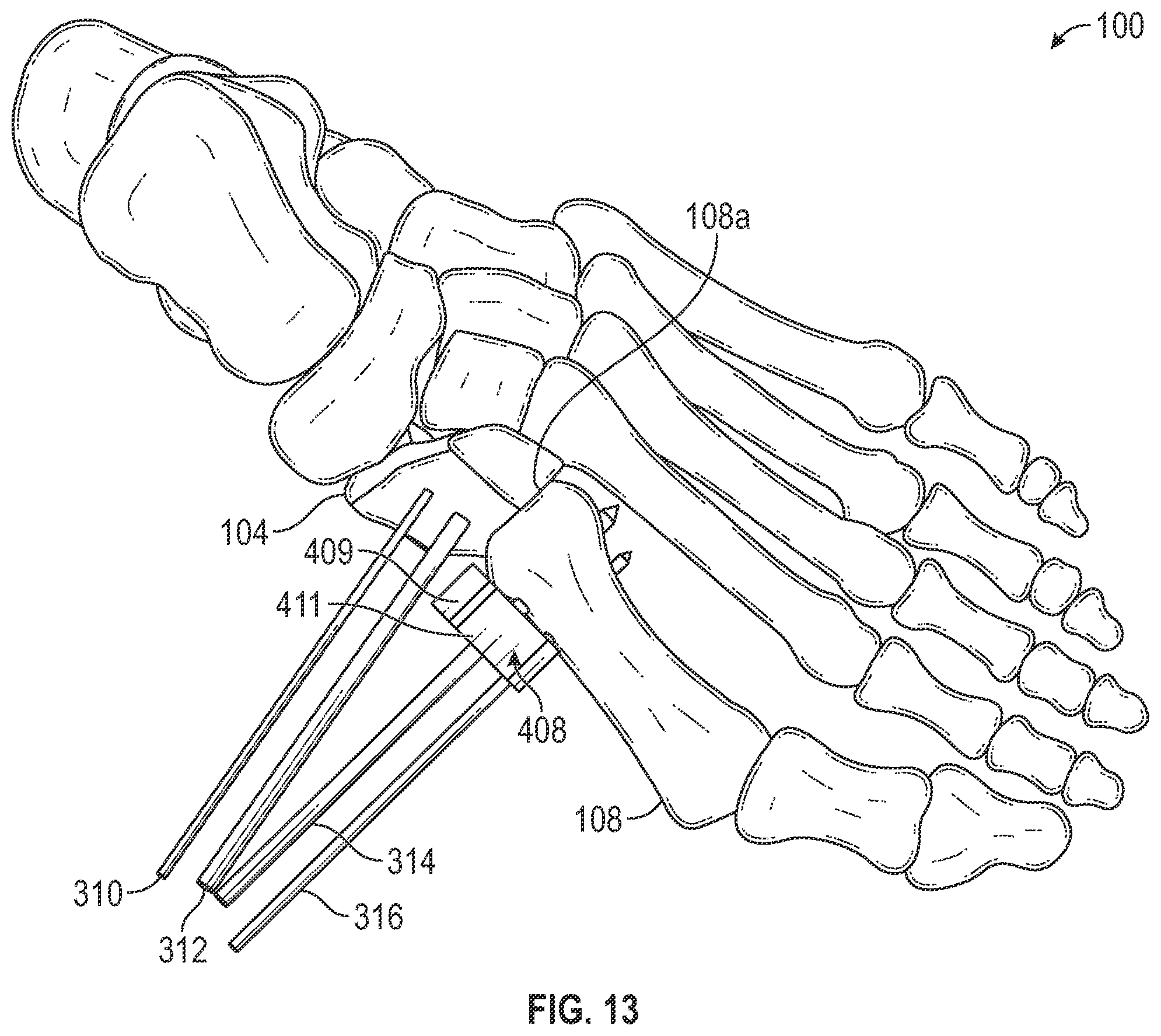 Patent US12403012 Figure 14 – Bone repositioning guide system and procedure