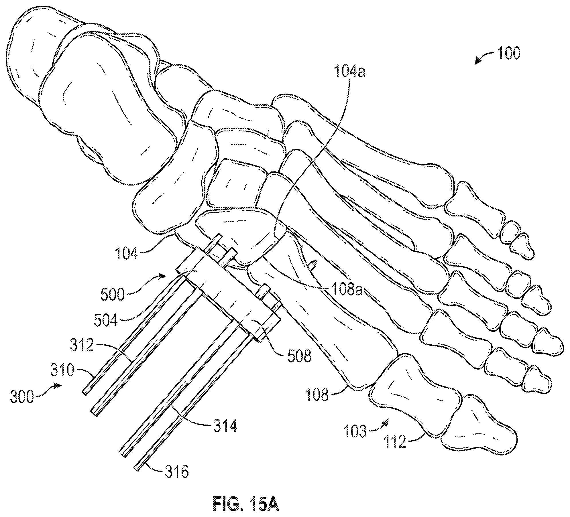 Patent US12403012 Figure 16 – Bone repositioning guide system and procedure