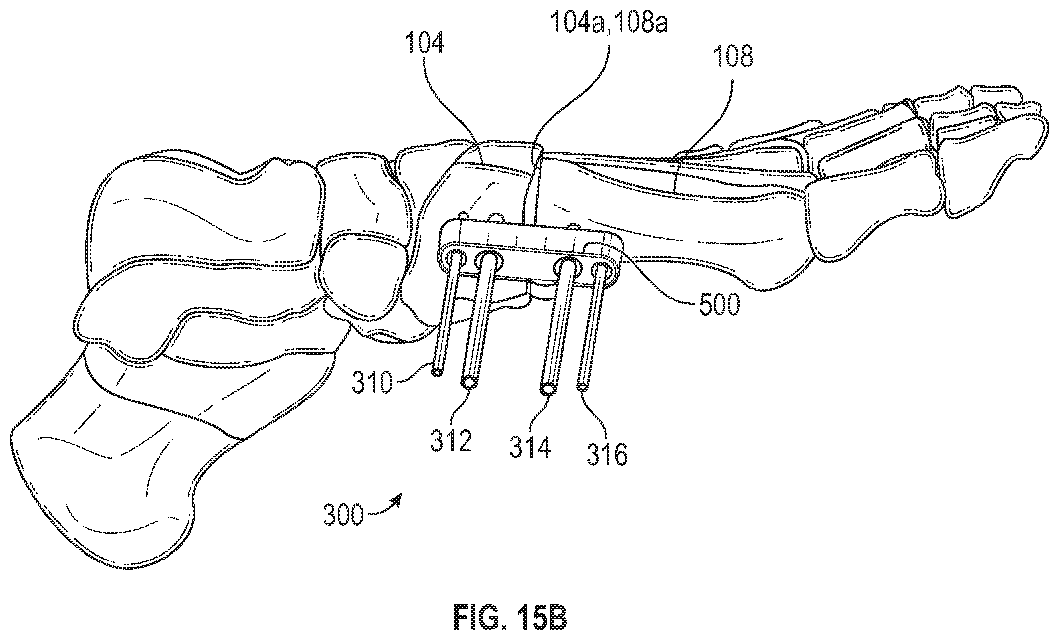Patent US12403012 Figure 17 – Bone repositioning guide system and procedure