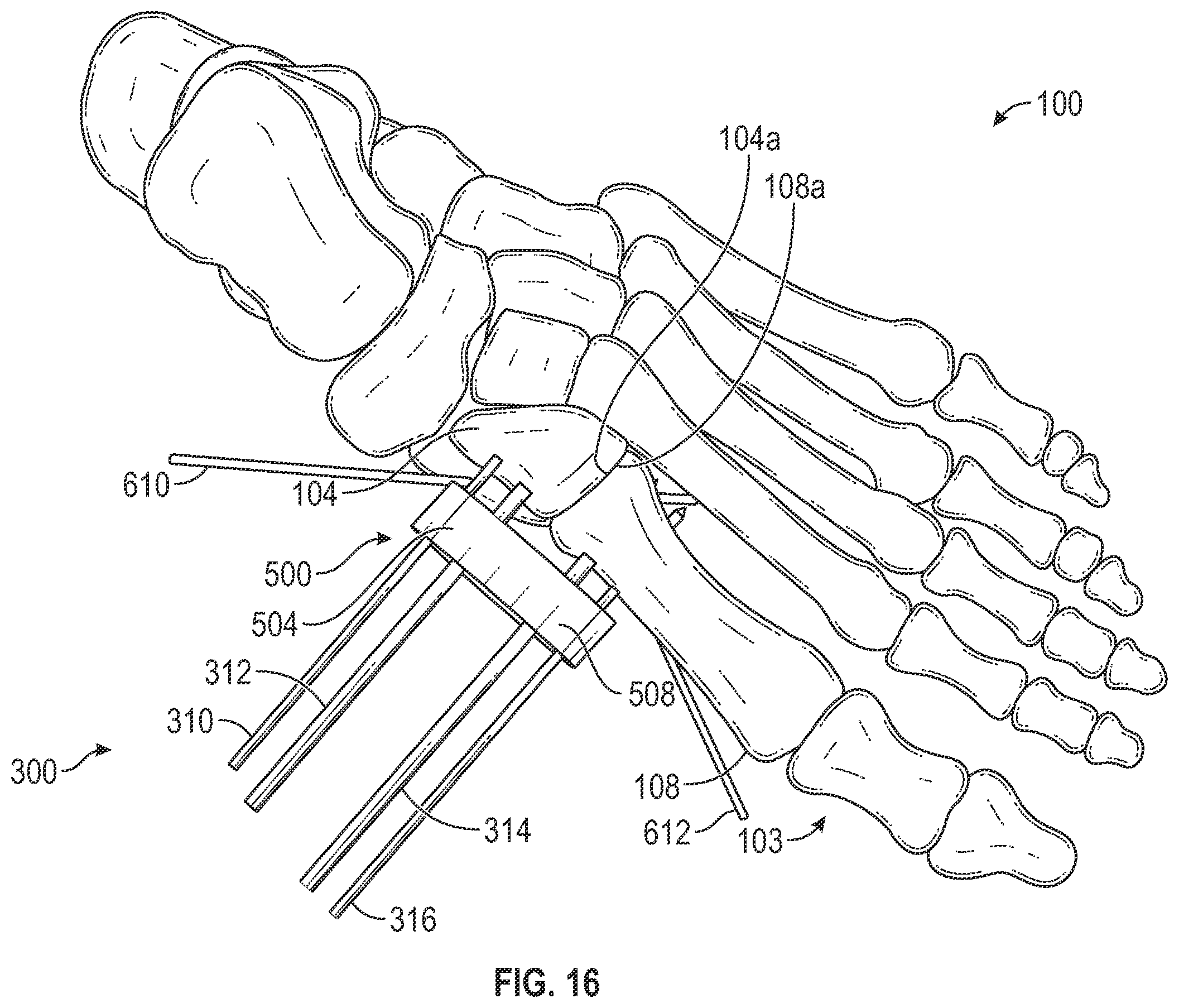 Patent US12403012 Figure 18 – Bone repositioning guide system and procedure