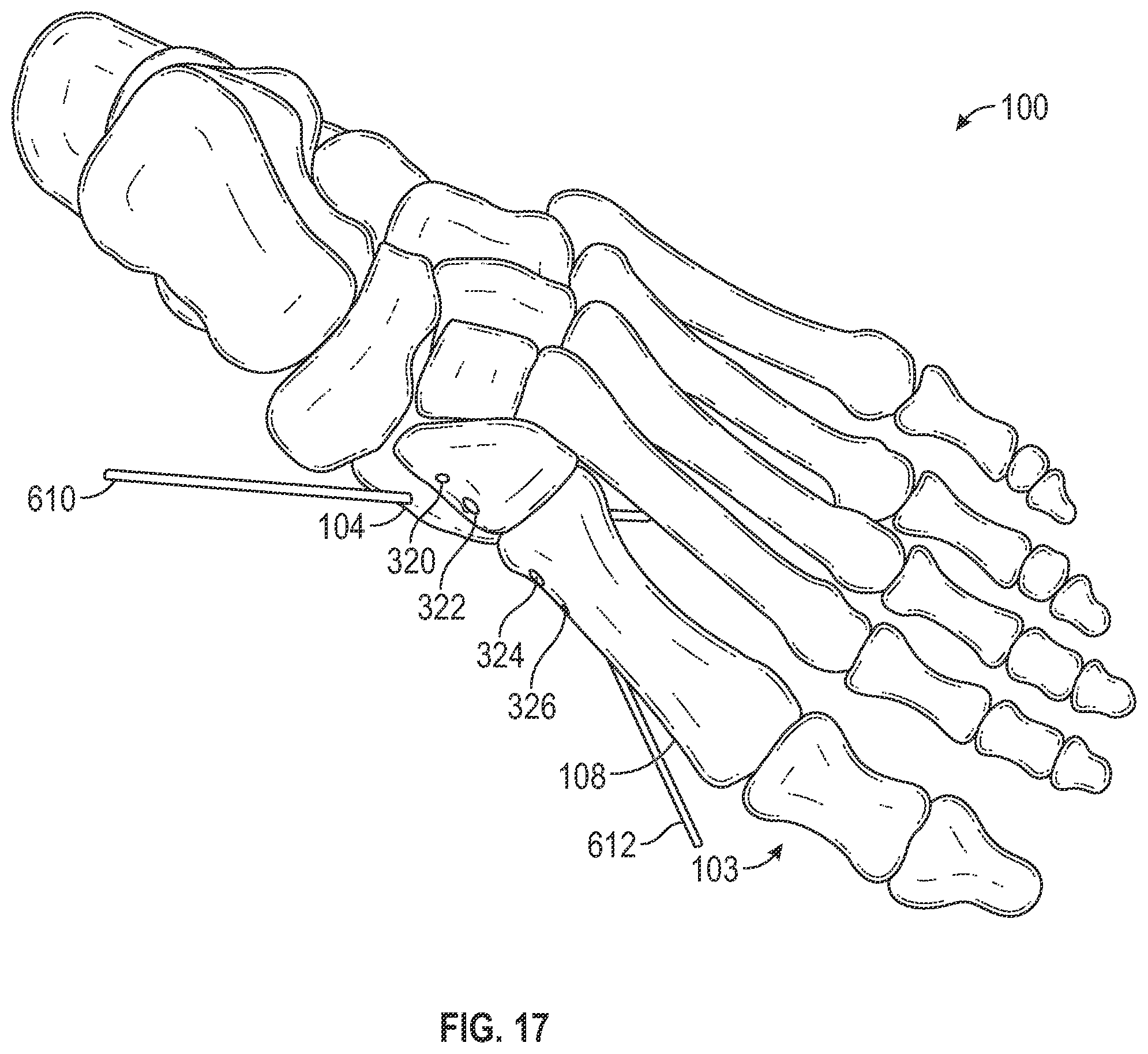 Patent US12403012 Figure 19 – Bone repositioning guide system and procedure
