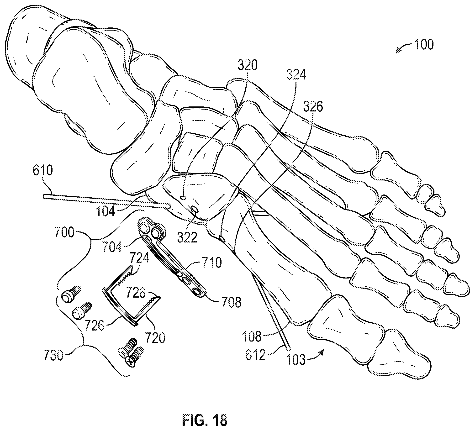 Patent US12403012 Figure 20 – Bone repositioning guide system and procedure