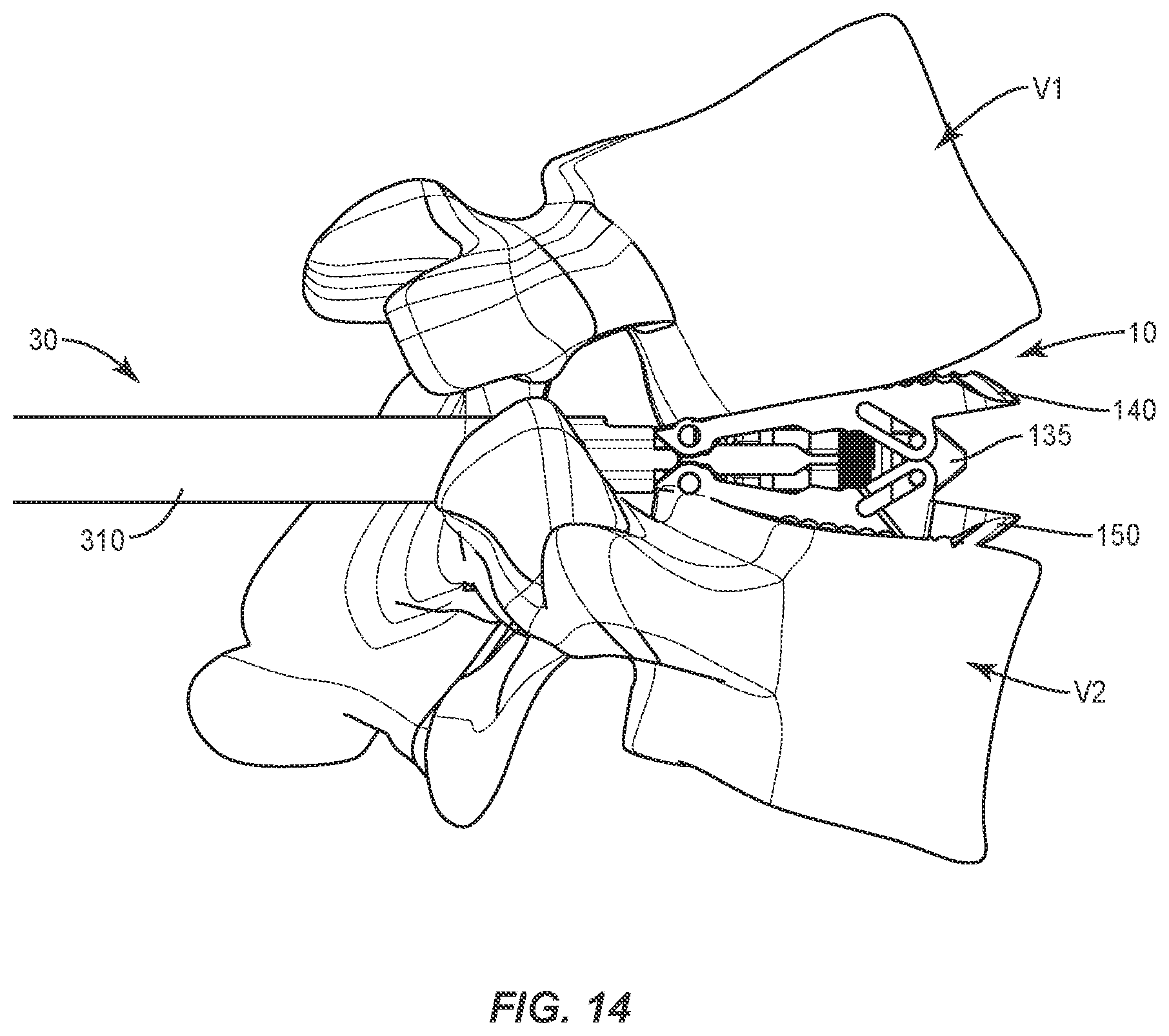 Patent US12403018 Figure 15 – Expandable spinal implant system and method of using same
