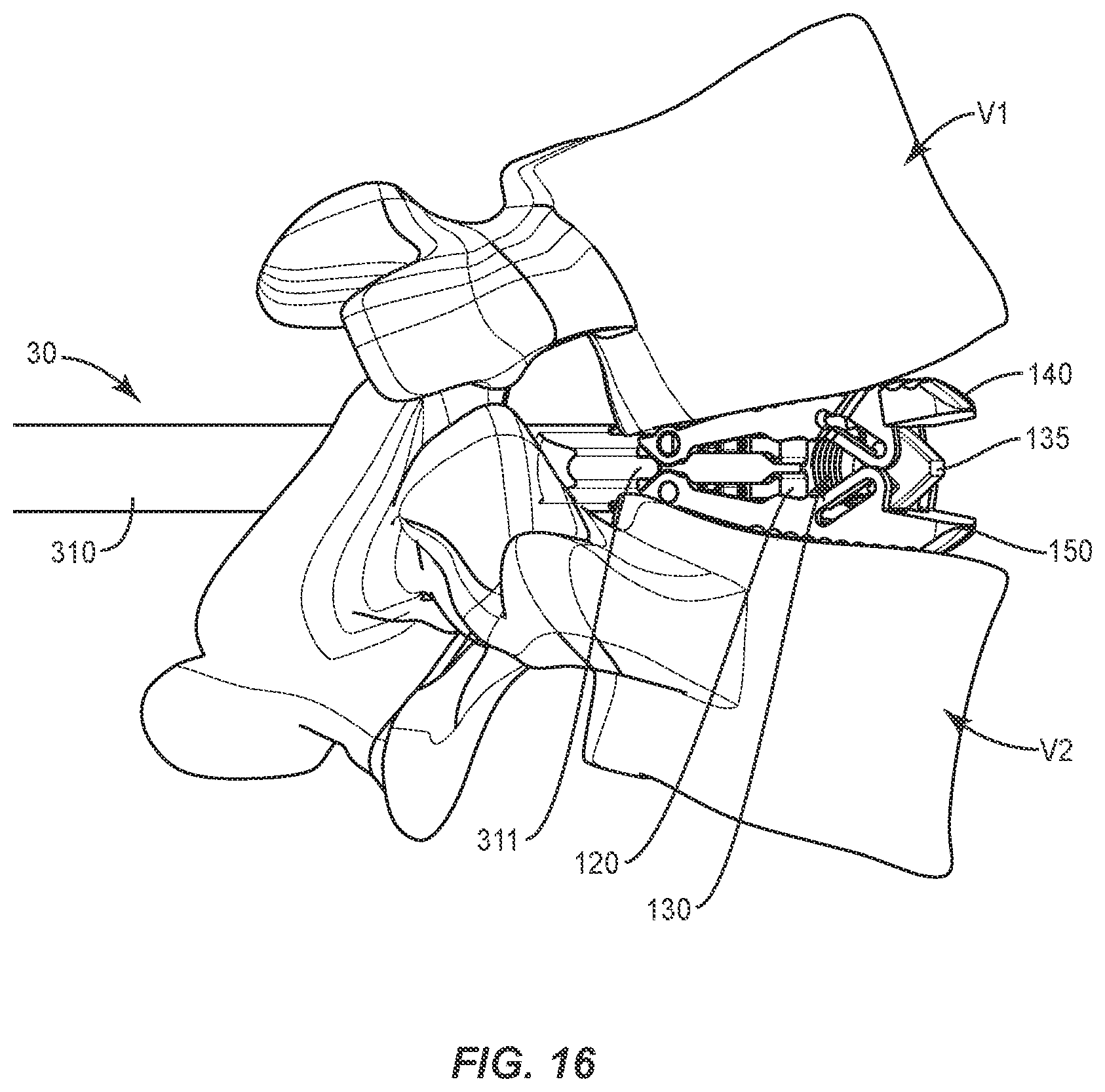 Patent US12403018 Figure 17 – Expandable spinal implant system and method of using same
