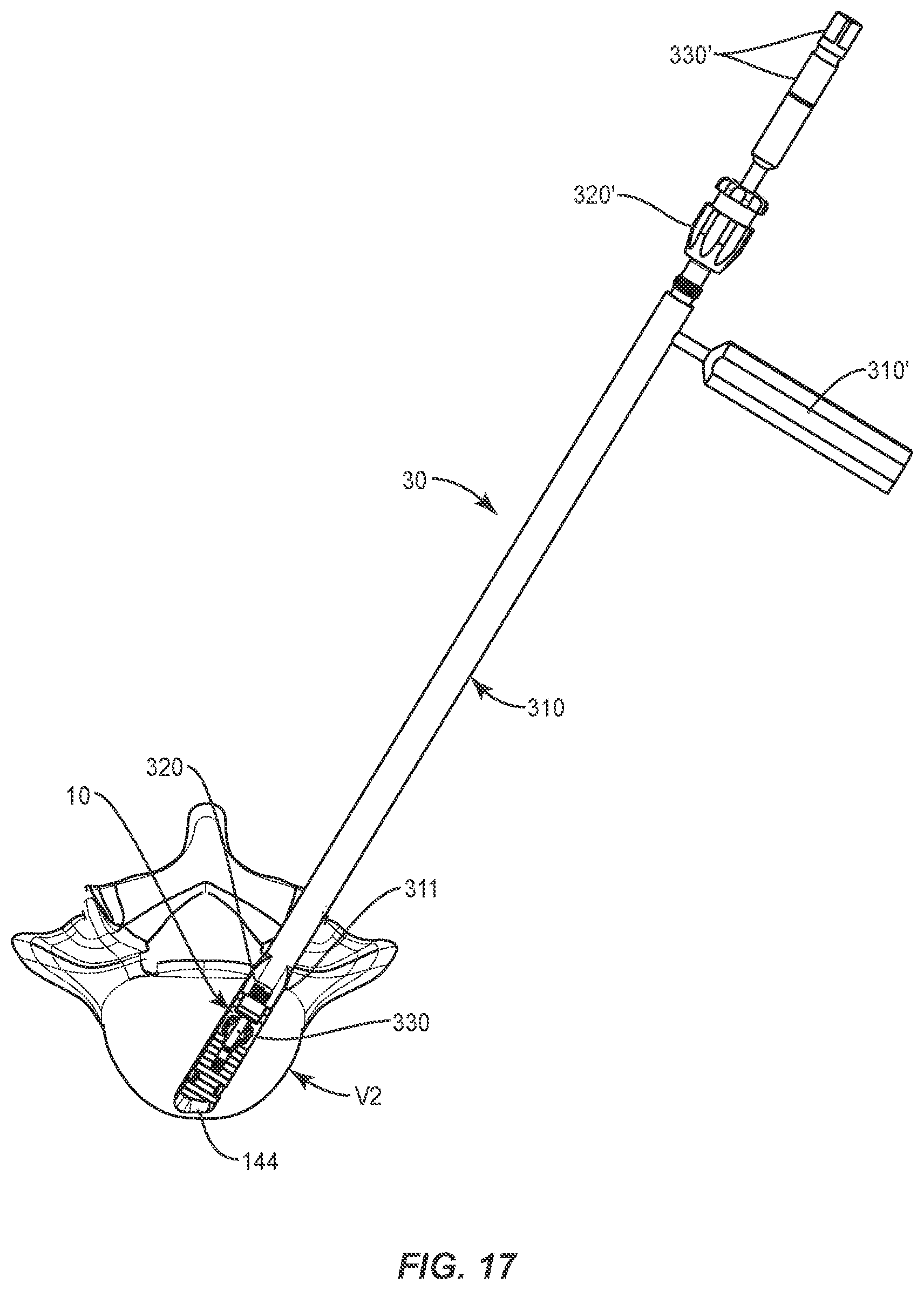 Patent US12403018 Figure 18 – Expandable spinal implant system and method of using same