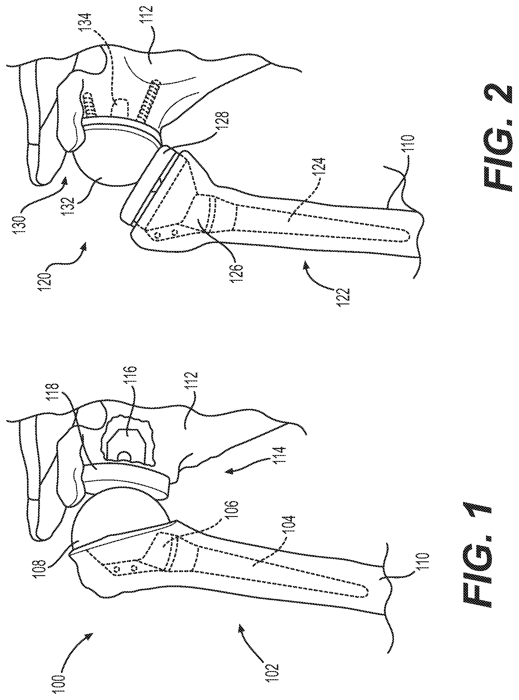 Patent US12403022 Figure 1 – Measurement system configured to support installation of a ball and socket joint and method therefor