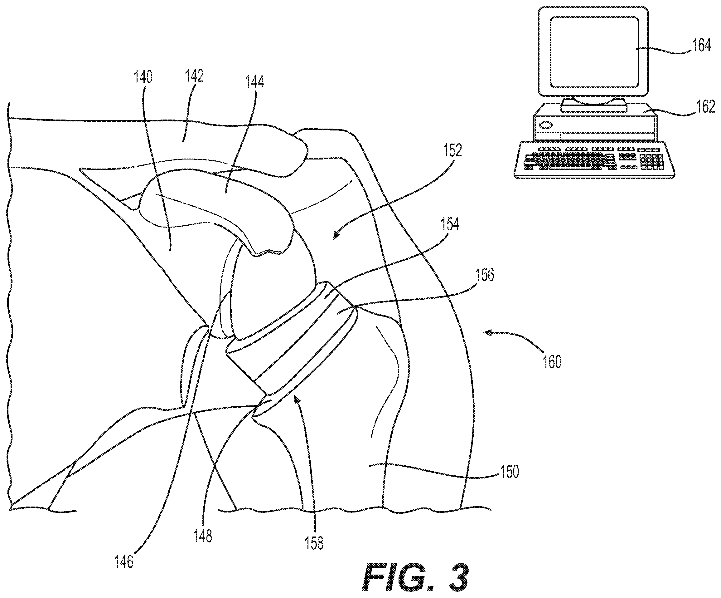 Patent US12403022 Figure 2 – Measurement system configured to support installation of a ball and socket joint and method therefor