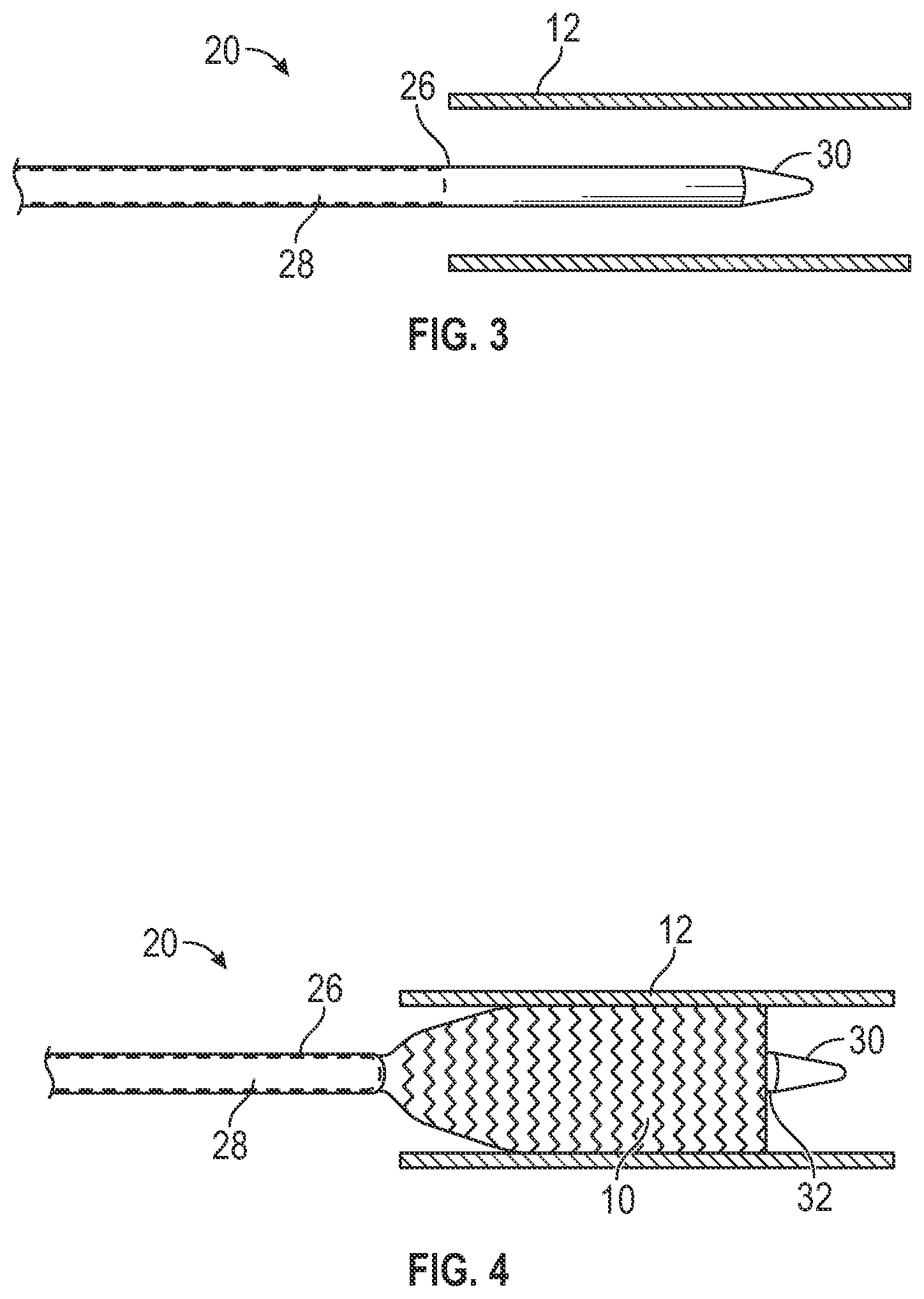 Patent US12403024 Figure 3 – Vascular and aortic grafts with telescoping sheath and deployment methods thereof