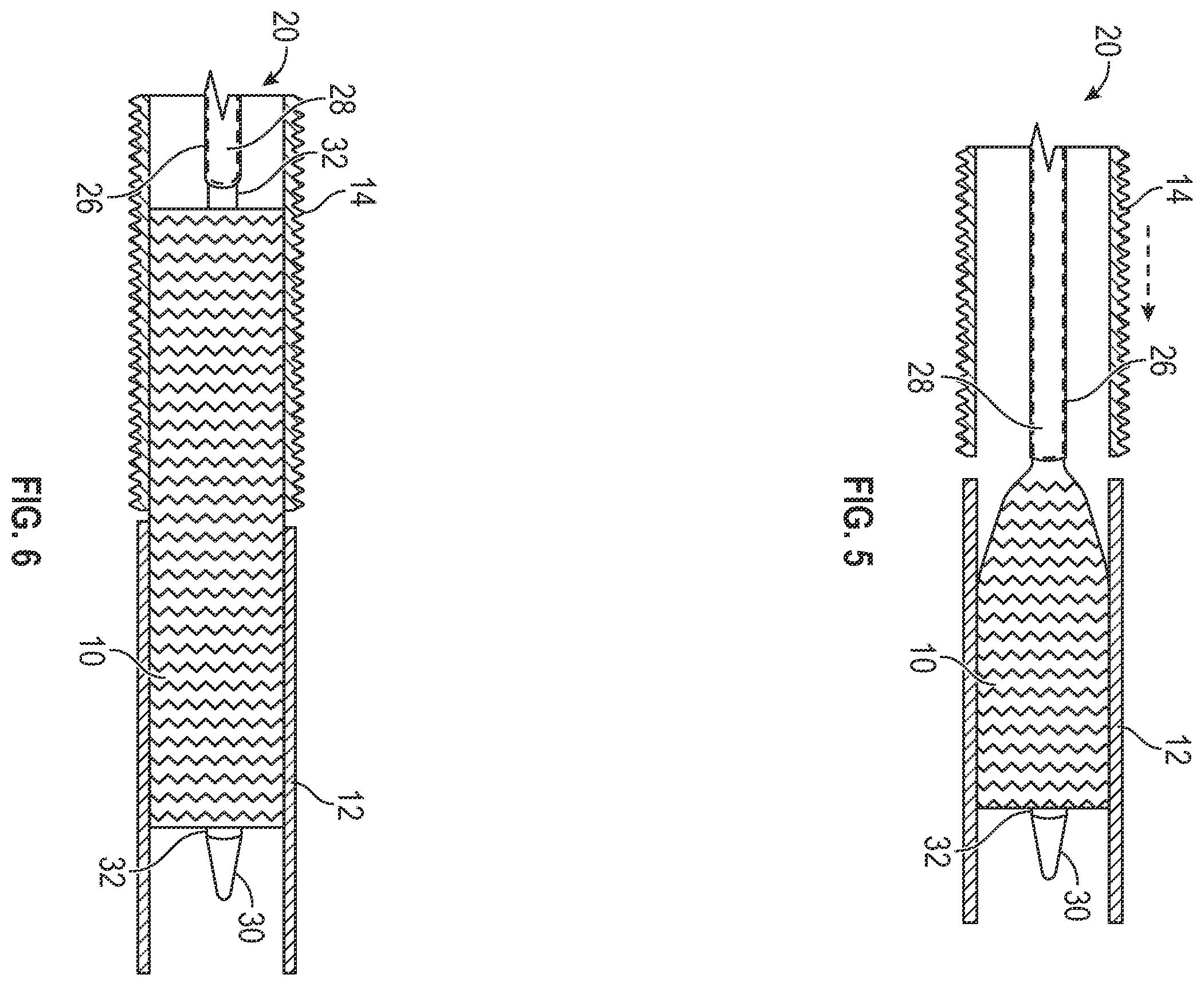 Patent US12403024 Figure 4 – Vascular and aortic grafts with telescoping sheath and deployment methods thereof