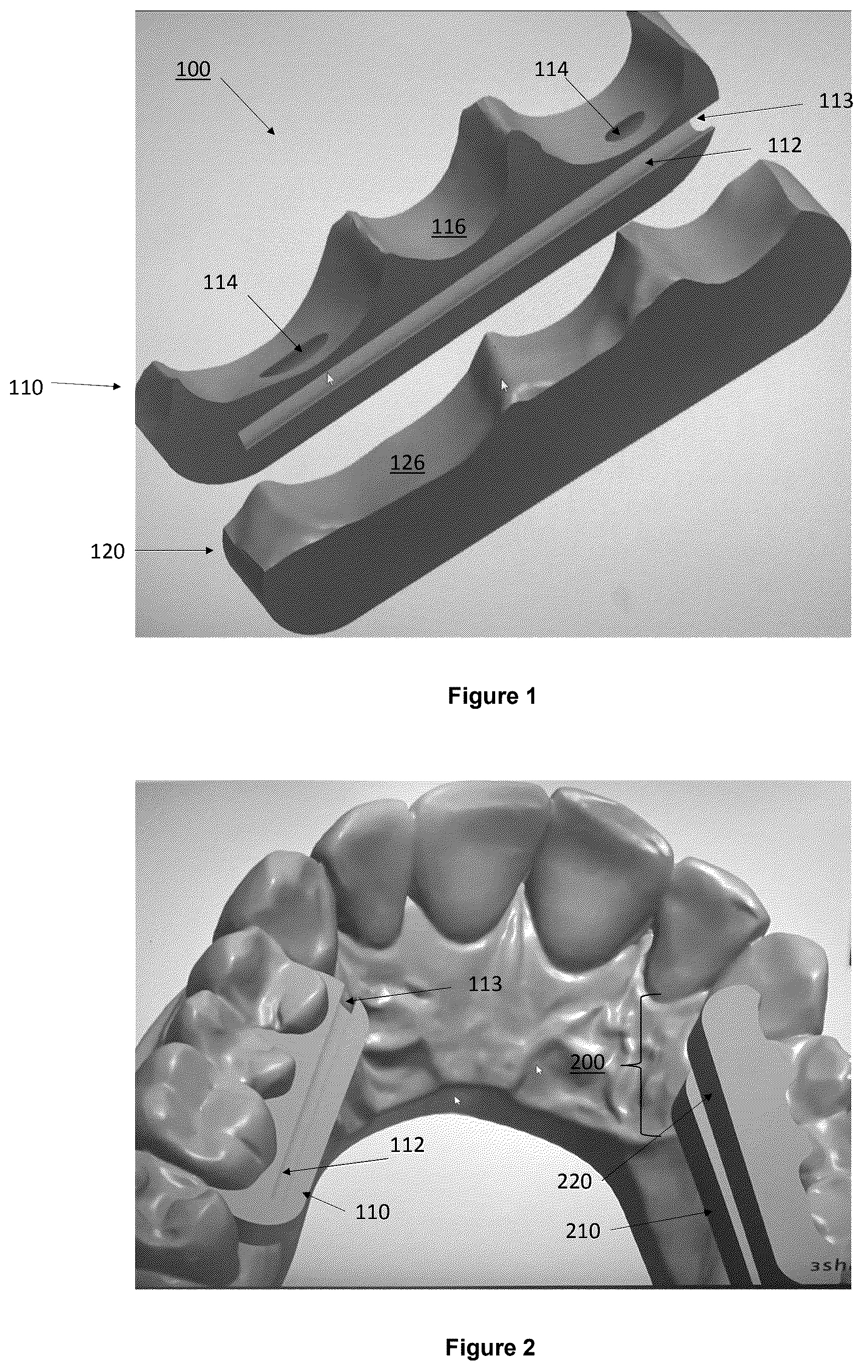 Patent US12403025 Figure 1 – Oral device to inhibit mastication and ingestion of solid food