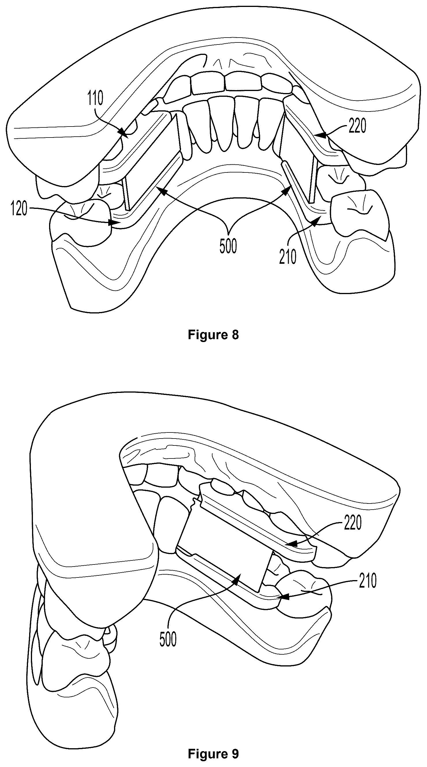 Patent US12403025 Figure 4 – Oral device to inhibit mastication and ingestion of solid food