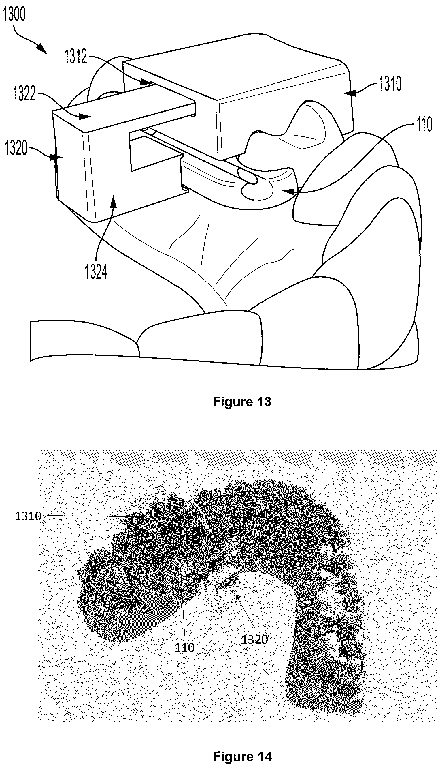 Patent US12403025 Figure 6 – Oral device to inhibit mastication and ingestion of solid food