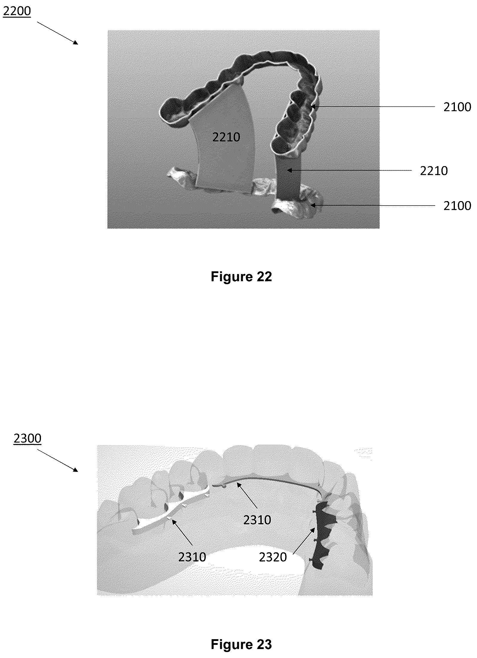 Patent US12403025 Figure 10 – Oral device to inhibit mastication and ingestion of solid food