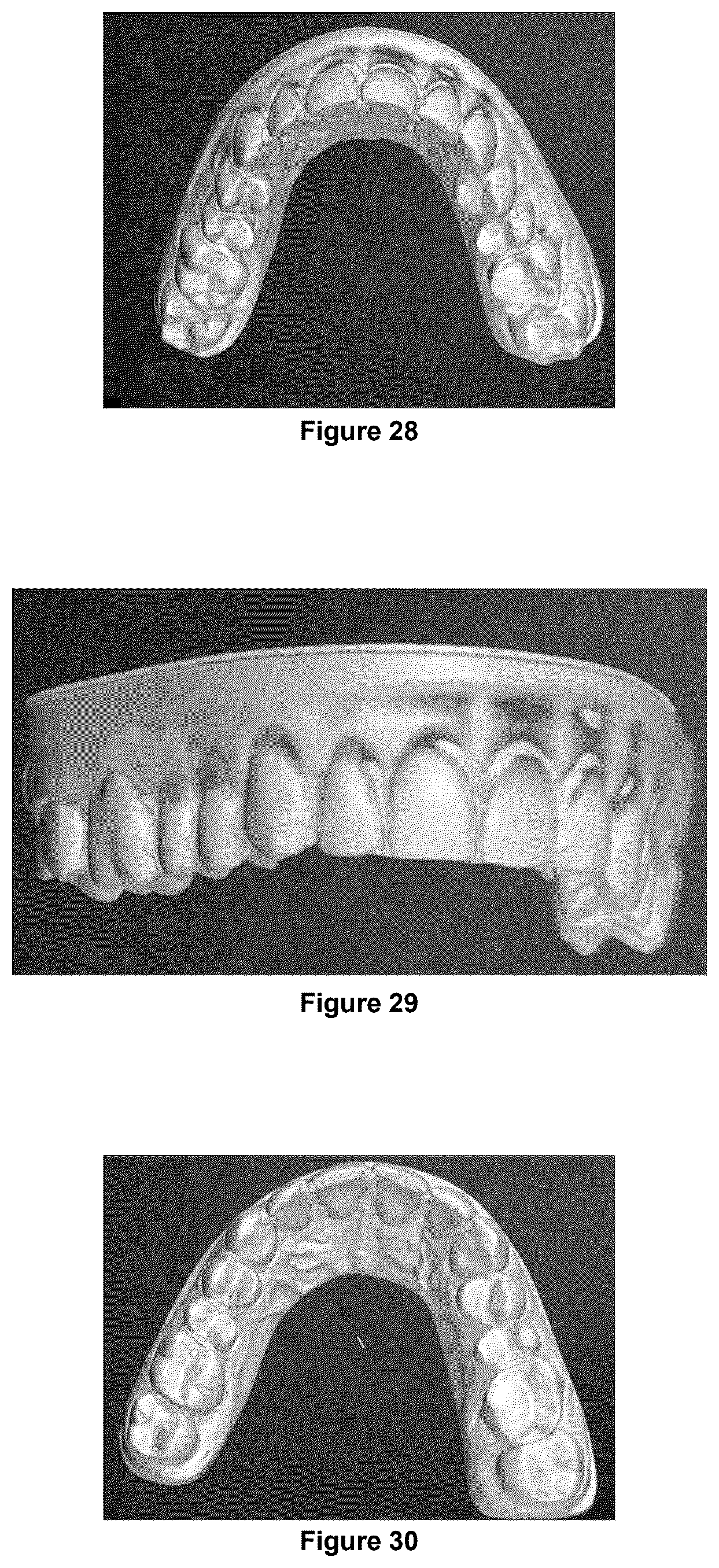 Patent US12403025 Figure 13 – Oral device to inhibit mastication and ingestion of solid food