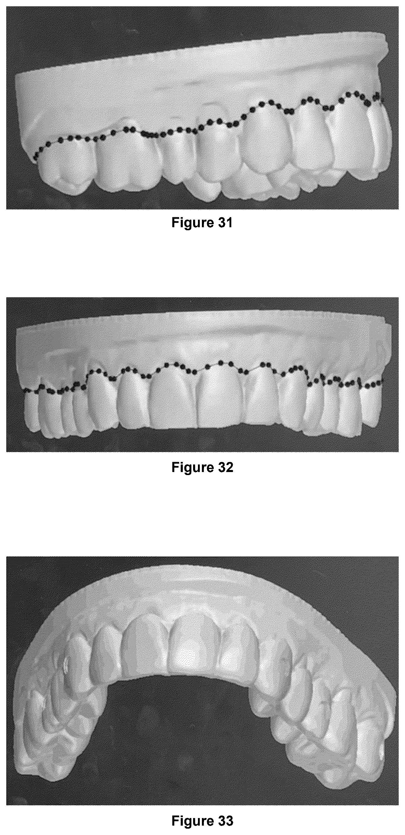 Patent US12403025 Figure 14 – Oral device to inhibit mastication and ingestion of solid food