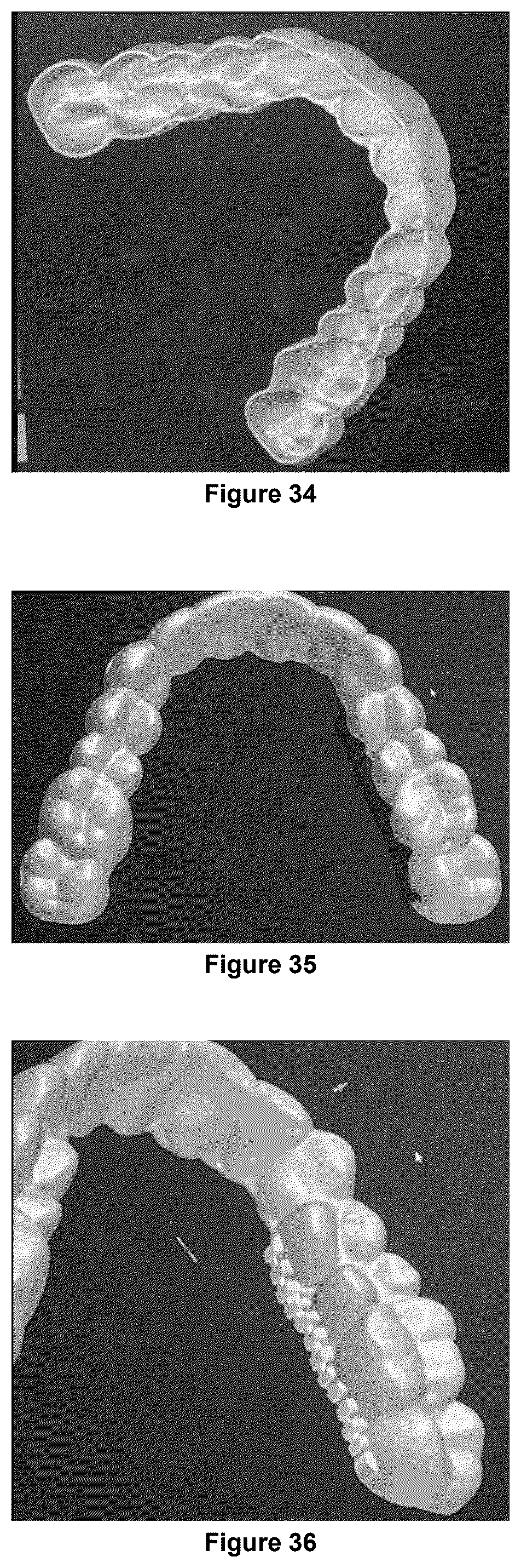 Patent US12403025 Figure 15 – Oral device to inhibit mastication and ingestion of solid food